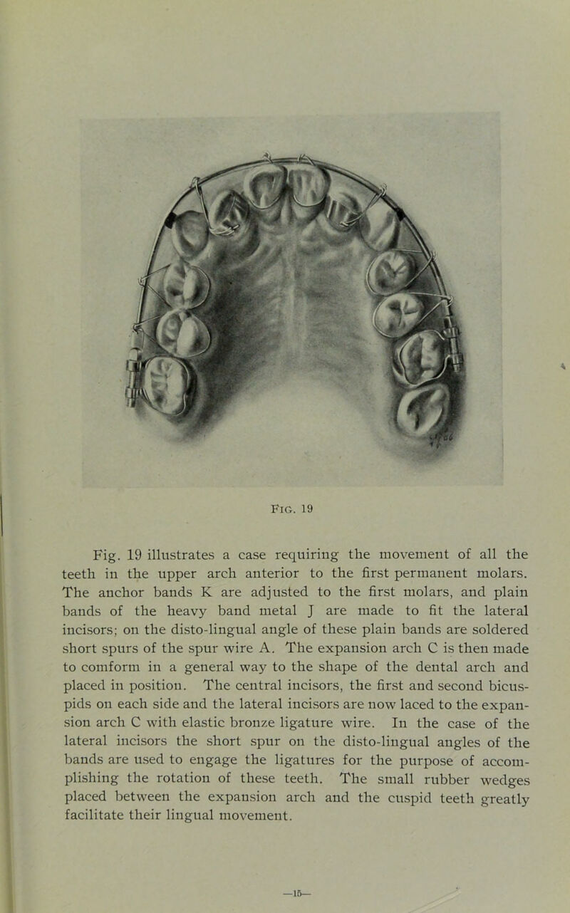 Fig. 19 illustrates a case requiring the movement of all the teeth in the upper arch anterior to the first permanent molars. The anchor bands K are adjusted to the first molars, and plain bands of the heavy band metal J are made to fit the lateral incisors; on the disto-lingual angle of these plain bands are soldered short spurs of the spur wire A. The expansion arch C is then made to coniform in a general way to the shape of the dental arch and placed in position. The central incisors, the first and second bicus- pids on each side and the lateral incisors are now laced to the expan- sion arch C with elastic bronze ligature wire. In the case of the lateral incisors the short spur on the disto-lingual angles of the bands are used to engage the ligatures for the purpose of accom- plishing the rotation of these teeth. The small rubber wedges placed between the expansion arch and the cuspid teeth greatly facilitate their lingual movement. —15—