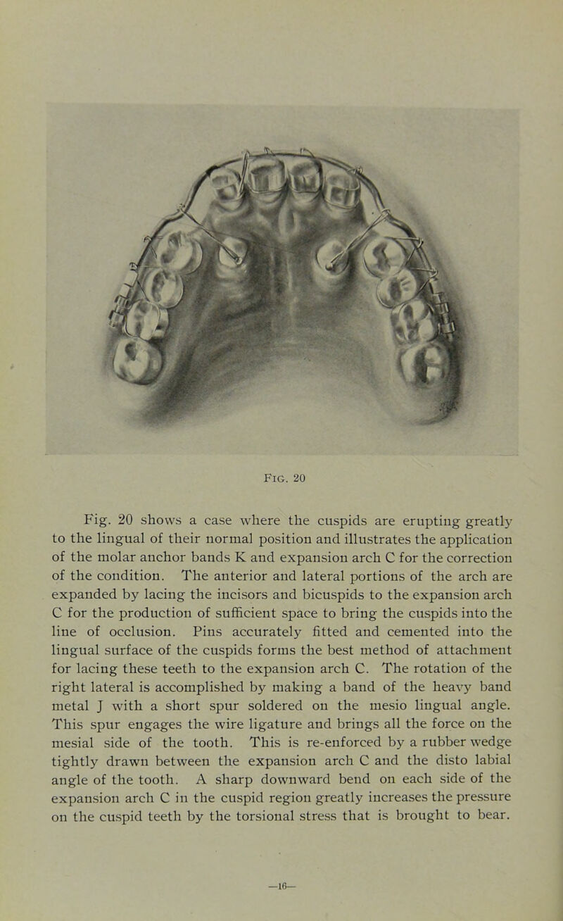 Fig. 20 shows a case where the cuspids are erupting greatly to the lingual of their normal position and illustrates the application of the molar anchor bands K and expansion arch C for the correction of the condition. The anterior and lateral portions of the arch are expanded by lacing the incisors and bicuspids to the expansion arch C for the production of sufficient space to bring the cuspids into the line of occlusion. Pins accurately fitted and cemented into the lingual surface of the cuspids forms the best method of attachment for lacing these teeth to the expansion arch C. The rotation of the right lateral is accomplished by making a band of the heavy band metal J with a short spur soldered on the mesio lingual angle. This spur engages the wire ligature and brings all the force on the mesial side of the tooth. This is re-enforced by a rubber wedge tightly drawn between the expansion arch C and the disto labial angle of the tooth. A sharp downward bend on each side of the expansion arch C in the cuspid region greatly increases the pressure on the cuspid teeth by the torsional stress that is brought to bear. —16—