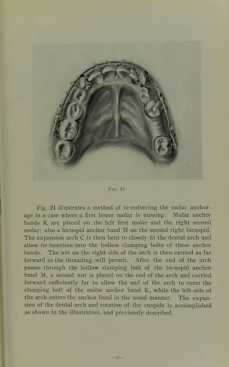 Fig. 21 illustrates a method of re-enforeing the molar anchor- age in a case where a first lower molar is missing. Molar anchor bands K are placed on the left first molar and the right second molar; also a bicuspid anchor band M on the second right bicuspid. The expansion arch C is then bent to closely fit the dental arch and allow its insertion into the hollow clamping bolts of these anchor bands. The nut on the right side of the arch is then carried as far forward as the threading will permit. After the end of the arch passes through the hollow clamping bolt of the bicuspid anchor band M, a second nut is placed on the end of the arch and carried forward sufficiently far to allow the end of the arch to enter the clamping bolt of the molar anchor band K, while the left side of the arch enters the anchor band in the usual manner. The expan- sion of the dental arch and rotation of the cuspids is accomplished as shown in the illustration, and previously described. — 17—