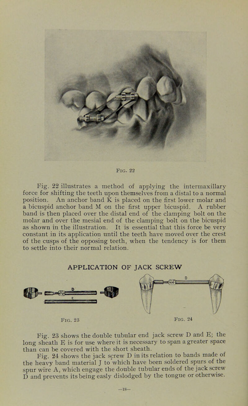Fig. 22 illustrates a method of applying the intermaxillary force for shifting the teeth upon themselves from a distal to a normal position. An anchor band K is placed on the first lower molar and a bicuspid anchor band M on the first upper bicuspid. A rubber band is then placed over the distal end of the clamping bolt on the molar and over the mesial end of the clamping bolt on the bicuspid as shown in the illustration. It is essential that this force be very constant in its application until the teeth have moved over the crest of the cusps of the opposing teeth, when the tendency is for them to settle into their normal relation. APPLICATION OF JACK SCREW Fig. 23 shows the double tubular end jack screw D and E; the long sheath E is for use where it is necessary to span a greater space than can be covered with the short sheath. Fig. 24 shows the jack screw D in its relation to bands made of the heavy band material J to which have been soldered spurs of the spur wire A, which engage the double tubular ends of the jack screw D and prevents its being easly dislodged by the tongue or otherwise. —18—