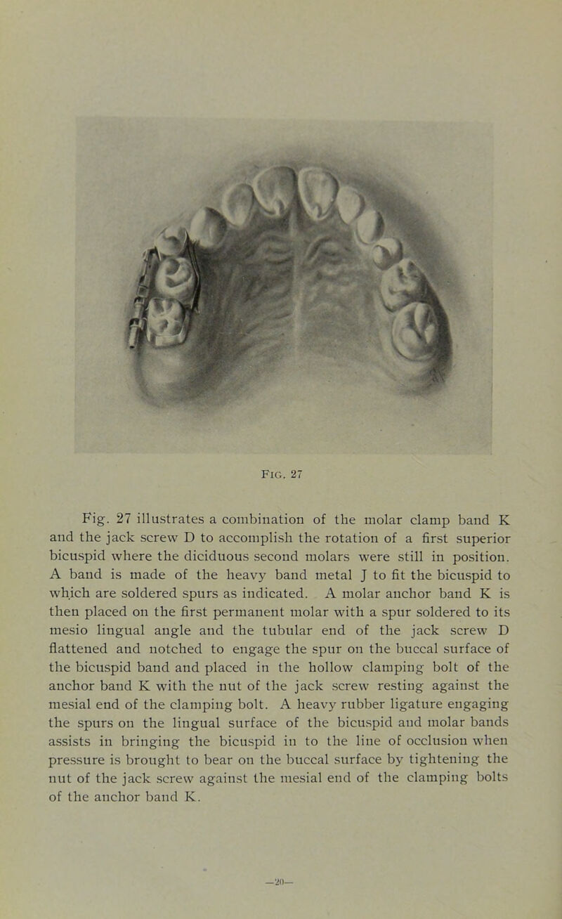 Fig. 27 illustrates a combination of the molar clamp band K and the jack screw D to accomplish the rotation of a first superior bicuspid where the diciduous second molars were still in position. A band is made of the heavy band metal J to fit the bicuspid to which are soldered spurs as indicated. A molar anchor band K is then placed on the first permanent molar with a spur soldered to its mesio lingual angle and the tubular end of the jack screw D flattened and notched to engage the spur on the buccal surface of the bicuspid band and placed in the hollow clamping bolt of the anchor band K with the nut of the jack screw resting against the mesial end of the clamping bolt. A heavy rubber ligature engaging the spurs on the lingual surface of the bicuspid and molar bands assists in bringing the bicuspid in to the line of occlusion when pressure is brought to bear on the buccal surface by tightening the nut of the jack screw against the mesial end of the clamping bolts of the anchor band K. —w—