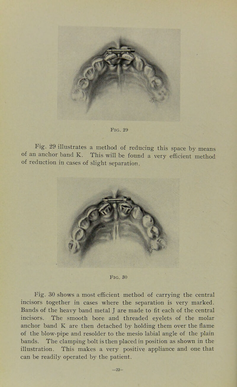 Fig. 29 illustrates a method of reducing this space by means of an anchor band K. This will be found a very efficient method of reduction in cases of slight separation. Fig. 30 shows a most efficient method of carrying the central incisors together in cases where the separation is very marked. Bands of the heavy band metal J are made to fit each of the central incisors. The smooth bore and threaded eyelets of the molar anchor band K are then detached by holding them over the flame of the blow-pipe and resolder to the mesio labial angle of the plain bands. The clamping bolt is then placed in position as shown in the illustration. This makes a very positive appliance and one that can be readily operated by the patient. Fig. 30 —22-