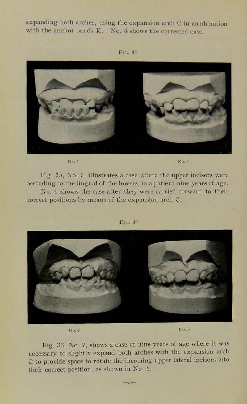 with the anchor bands K. No. 4 shows the corrected case. Fig. 35 No. 5 No. 6 Fig. 35, No. 5, illustrates a case where the upper incisors were occluding to the lingual of the lowers, in a patient nine years of age. No. 6 shows the case after they were carried forward to their correct positions by means of the expansion arch C. Fig. 3<; No. 7 Fig. 36, No. 7, shows a case at nine years of age where it was necessary to slightly expand both arches with the expansion arch C to provide space to rotate the incoming upper lateral incisors into their correct position, as shown in No 8. —26—