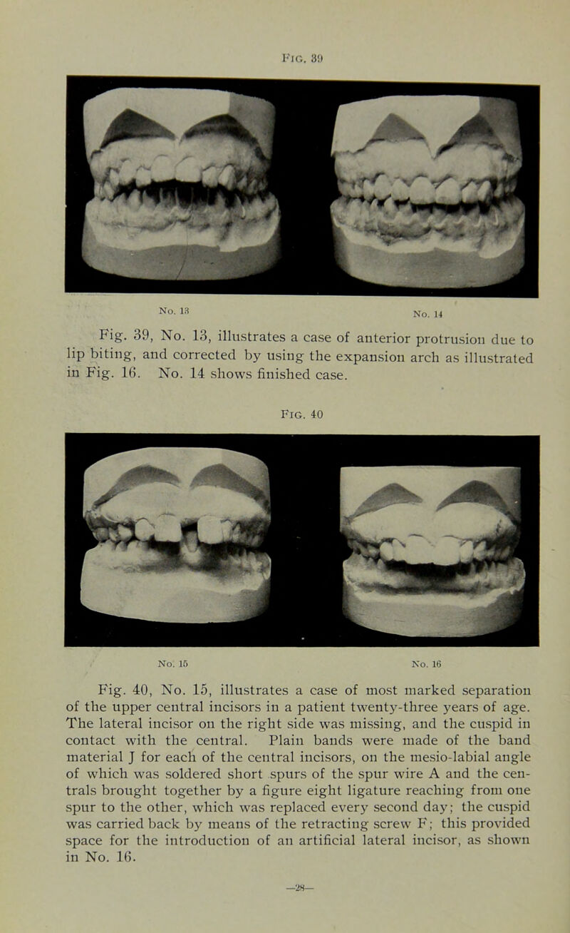 Fig. 39, No. 13, illustrates a ease of anterior protrusion due to lip biting, and corrected by using the expansion arch as illustrated in Fig. 16. No. 14 shows finished case. Fig. 40 No. 15 No. 16 Fig. 40, No. 15, illustrates a case of most marked separation of the upper central incisors in a patient twenty-three years of age. The lateral incisor on the right side was missing, and the cuspid in contact with the central. Plain bands were made of the band material J for each of the central incisors, on the mesio-labial angle of which was soldered short spurs of the spur wire A and the cen- trals brought together by a figure eight ligature reaching from one spur to the other, which was replaced every second day; the cuspid was carried back by means of the retracting screw F; this provided space for the introduction of an artificial lateral incisor, as shown in No. 16. —28—