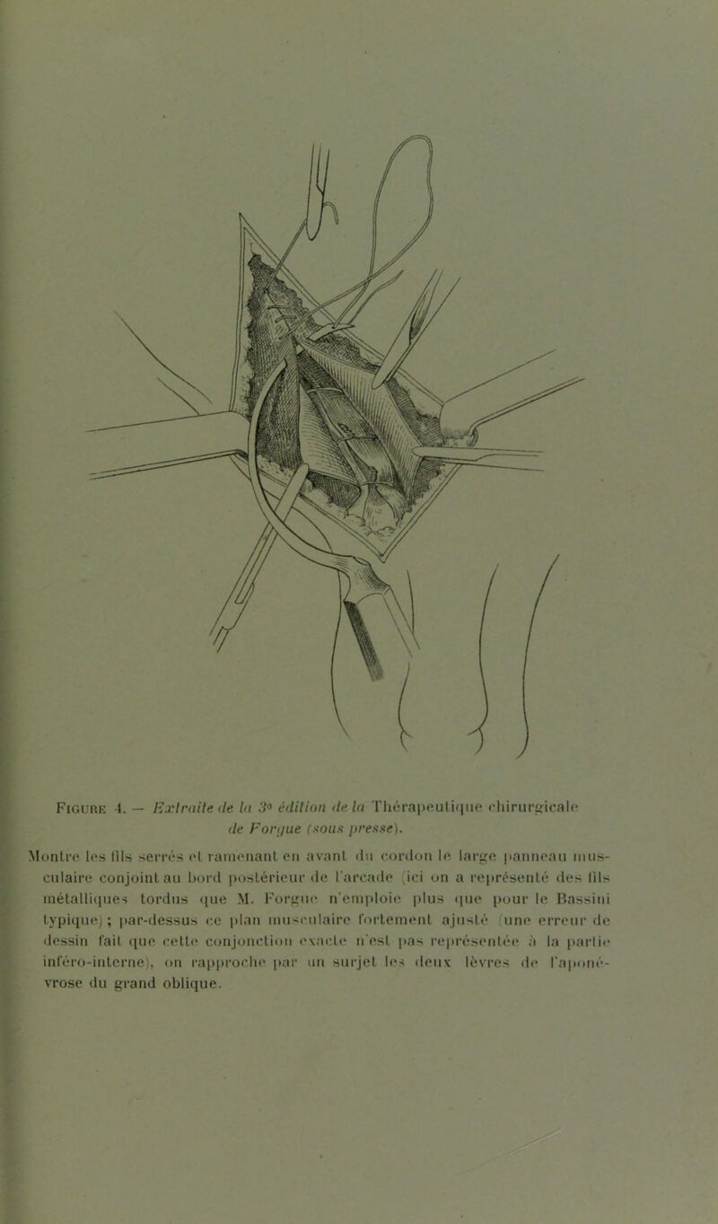 Figure 4. — Extraite cle la 3° édition delà Thérapeutique chirurgicale de Forijue (sous presse). Montre les lils serrés el ramenant eu avant du cordon le large panneau mus- culaire conjoint au bord postérieur de l’arcade ici on a représenté des lils métalliques tordus que M. Forgue n'emploie plus «pie pour le Bassini typique); par-dessus ce plan musculaire fortement ajusté (une erreur de dessin fait que cette conjonction exacte n'est pas représentée à la partie inféro-interne), on rapproche par un surjet les deux lèvres de l'aponé- vrose du grand oblique.