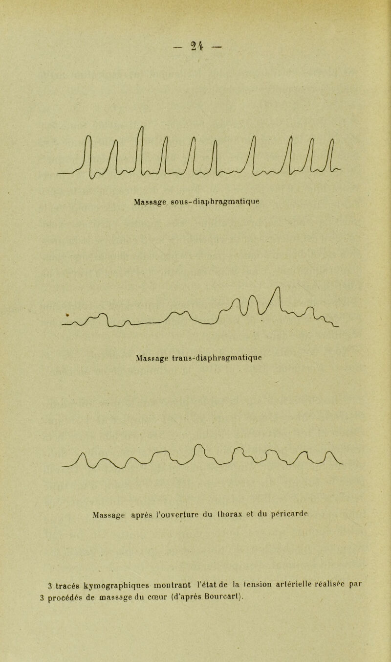 - Massage sous-diaphragmatiqiie Massage trans-diaphragmatique Massage après l’ouverture du thorax et du péricarde 3 tracés kymographiques montrant l’état de la tension artérielle réalisée par