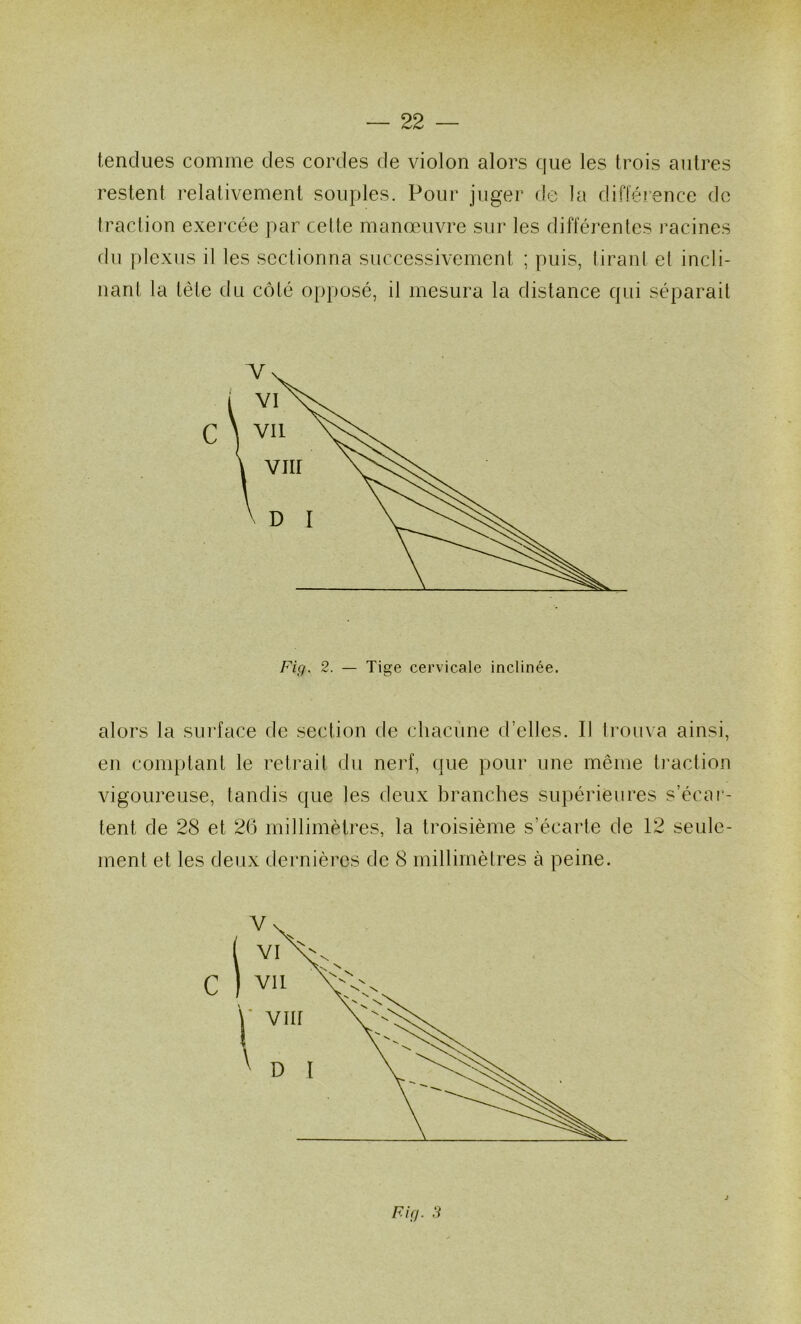 tendues comme des cordes de violon alors ([ue les trois autres restent relativement souples. Pour juger de la différence do traction exercée par cette manœuvre sur les différentes racines du })lexns il les sectionna successivement ; puis, tirant et incli- nant la tète du côté o[>posé, il mesura la distance qui séparait Fig. 2. — Tige cervicale inclinée. alors la surface de section de chacune d’elles. Il trouva ainsi, en comptant le retrait du nerf, que pour une même traction vigoureuse, tandis que les deux branches supérieures s’écar- tent de 28 et 2(3 millimètres, la troisième s’écarte de 12 seule- ment et les deux dernières de 8 millimètres à peine. Fig. H