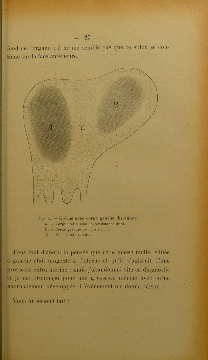 fond de l’organe ; il ne me semble pas que ce sillon se con- tinue sur la face antérieure. Fig I. — Utérus avec corne gauche distendue A. — Corps utérin vide de consistance dure. B. — Corne gravide de consistance. C. — Zone intermédiaire. J’eus tout d’abord la pensée que cette masse molle, située à gauche était tangente à l’utérus et qu’il s’agissait d’une grossesse extra-utérine ; mais j’abandonnai vite ce diagnostic et je me prononçai pour une grossesse utérine avec corne anormalement développée. L’événement me donna raison ». Voici un second fait :