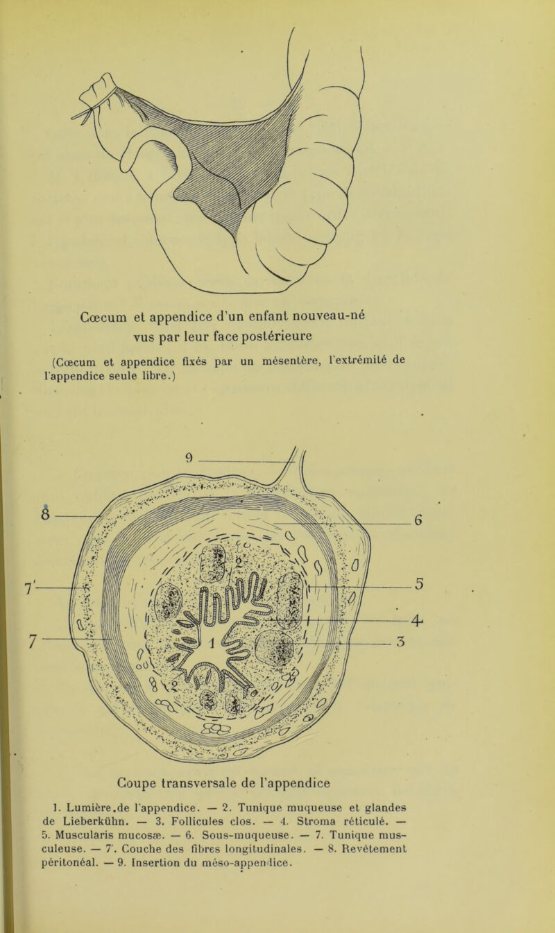 Cæcum et appendice d'un enfant nouveau-né vus par leur face postérieure (Cæcum et appendice fixés par un mésentère, l’extrémité de l'appendice seule libre.) Coupe transversale de l’appendice 1. Lumière.de l’appendice. — 2. Tunique muqueuse et glandes de Lieberkühn. — 3. Follicules clos. — 4. Stroma réticulé. — 5. Muscularis mucosæ. — 6. Sous-muqueuse. — 7. Tunique mus- culeuse. — T. Couche des fibres longitudinales. — 8. Revêtement péritonéal. —9. Insertion du méso-appendice.