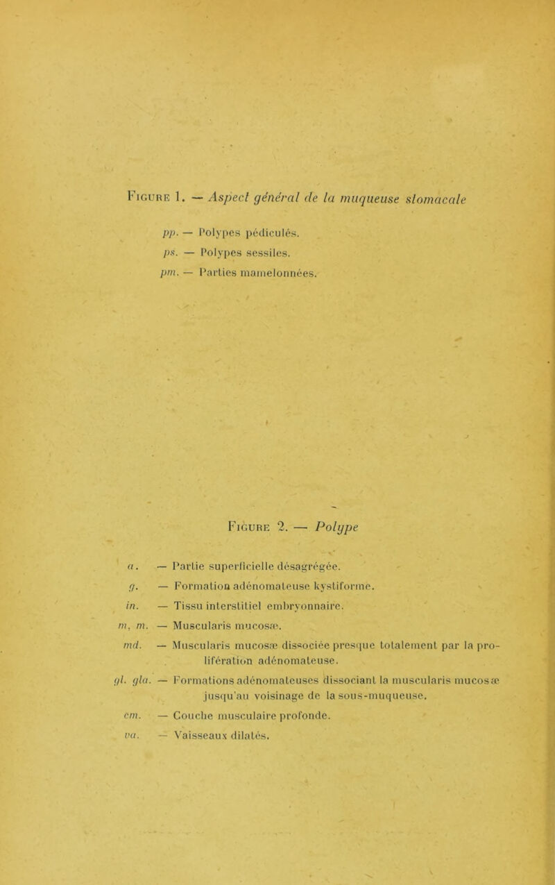 Figure 1. — Aspect général île la muqueuse stomacale pp. — Polypes pédicules. ps. — Polypes sessiles. pni. — l’arties mamelonnées. » Figure 2. — Polype a. — Partie superficielle désagrégée. ,7. — Formation adénomateuse kysliforme. in. — Tissu interstitiel embryonnaire. m, m. — Muscularis mucosa\ nui. — Muscularis mucosæ dissociée presque totalement par la pro- lifération adénomateuse. 7/. glu. — Formations adénomateuses dissociant la muscularis mucosæ jusqu’au voisinage de la sous-muqueuse. cm. — Couche musculaire profonde. — Vaisseaux dilatés. vu.