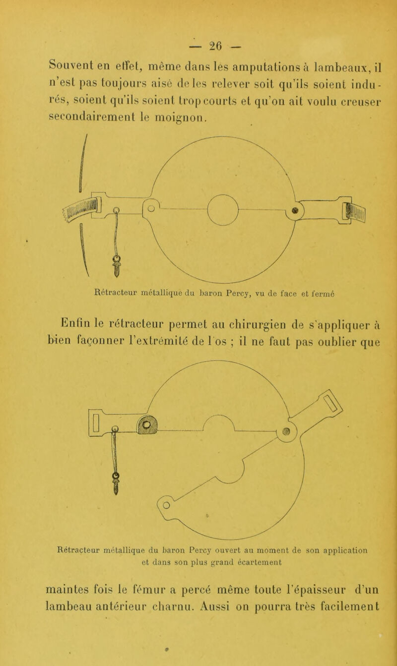 Souvent en etfet, même dans les amputations cà lambeaux, il n’est pas toujours aisé do les relever soit qu’ils soient indu- rés, soient qu’ils soient trop courts et qu’on ait voulu creuser secondairement le moignon. Rétracteur métallique du baron Percy, vu de face et ferme Knün le rétracteur permet au chirurgien de s'appliquer à bien façonner l’extrémité de l os ; il ne faut pas oublier que Rétracteur métallique du baron Percy ouvert au moment de son application et dans son plus j(rand écartement maintes fois le fémur a percé même toute l’épaisseur d’un lambeau antérieur charnu. Aussi on pourra très facilement