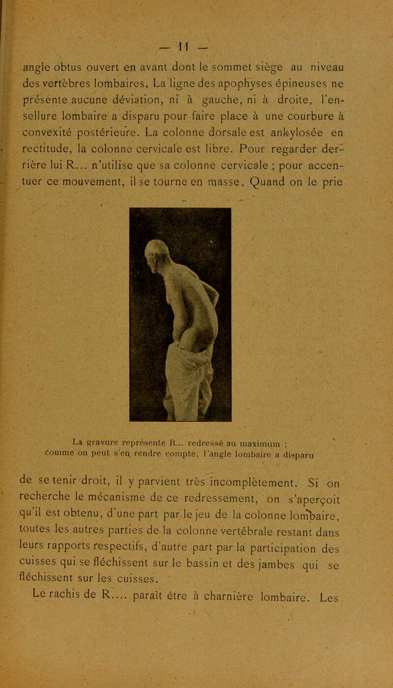 H angle obtus ouvert en avant dont le sommet siège au niveau des vertèbres lombaires. La ligne des apophyses épineuses ne présente aucune déviation, ni' à gauche, ni à droite, l’en- sellure lombaire a disparu pour faire place à une courbure à convexité postérieure. La colonne dorsale est ankylosée en rectitude, la colonne cervicale est libre. Pour regarder der- rière lui R... n’utilise que sa colonne cervicale ; pour accen- tuer ce mouvement, il se tourne en masse. Quand on le prie La gravure représente R... redressé au maximum ; comme on peut s’eg rendre compte, l'angle lombaire a disparu de se tenir droit, il y parvient très incomplètement. Si on recherche le mécanisme de ce redressement, on s’aperçoit qu’il est obtenu, d’une part par le jeu de la colonne lombaire, toutes les autres parties de la colonne vertébrale restant dans leurs rapports respectifs, d autre part par la participation des cuisses qui se fléchissent sur le bassin et des jambes qui se fléchissent sur les cuisses. Le rachis de R.... paraît être à charnière lombaire. Les