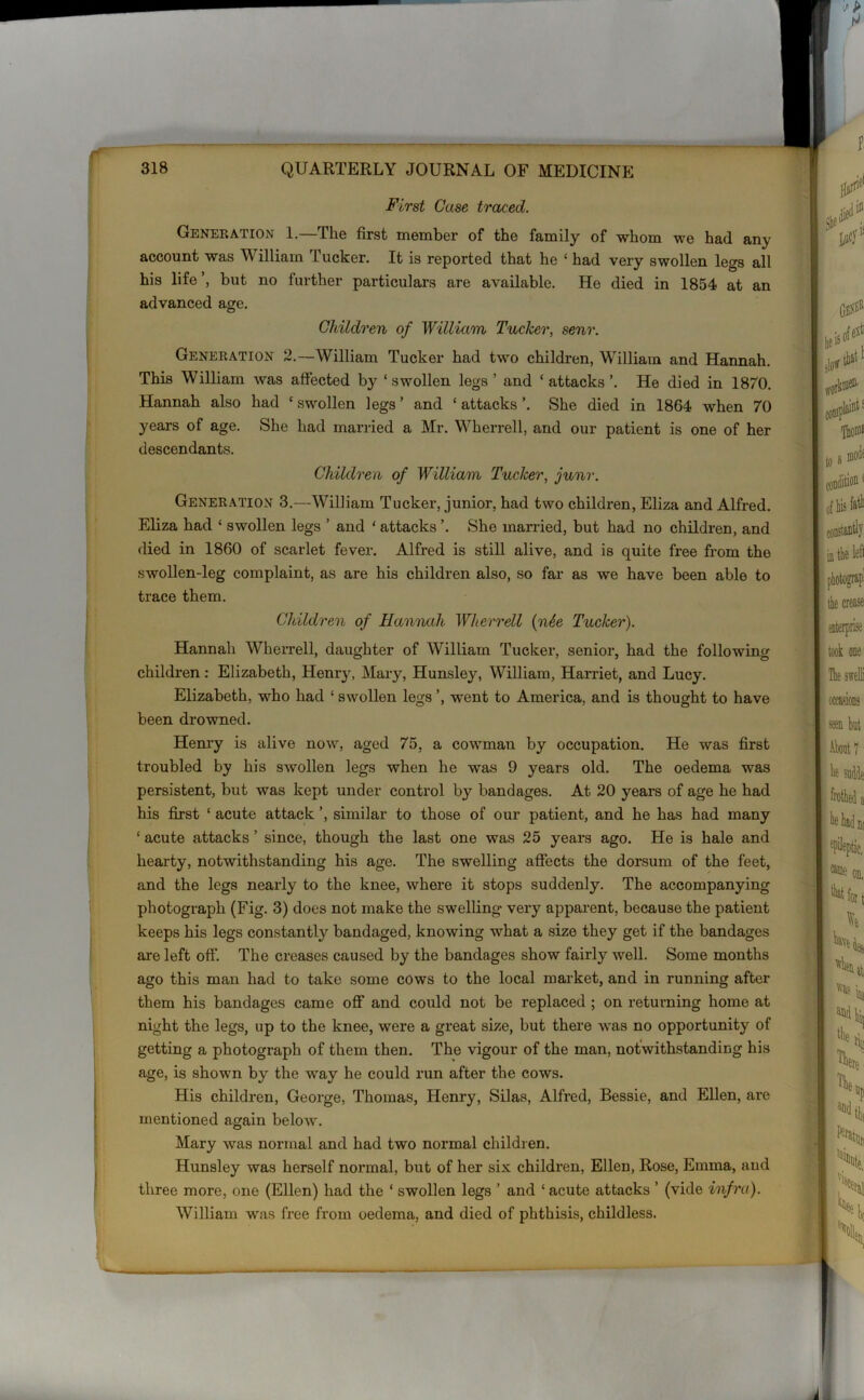 First Case traced. Generation 1.—The first member of the family of whom we had any account was William Tucker. It is reported that he ‘ had very swollen legs all his life but no further particulars are available. He died in 1854 at an advanced age. Children of William Tucker, senr. Generation 2.—William Tucker had two children, William and Hannah. This William was affected by ‘swollen legs ’ and ‘ attacks ’. He died in 1870. Hannah also had c swollen legs ’ and ‘ attacks ’. She died in 1864 when 70 years of age. She had married a Mr. Wherrell, and our patient is one of her descendants. Children of William Tucker, junr. Generation 3.—William Tucker, junior, had two children, Eliza and Alfred. Eliza had ‘ swollen legs ’ and ‘ attacks ’. She married, but had no children, and died in 1860 of scarlet fever. Alfred is still alive, and is quite free from the swollen-leg complaint, as are his children also, so far as we have been able to trace them. Children of Hannah Wherrell (nSe Tucker). Hannah Wherrell, daughter of William Tucker, senior, had the following children: Elizabeth, Henry, Mary, Hunsley, William, Harriet, and Lucy. Elizabeth, who had ‘ swollen legs ’, went to America, and is thought to have been drowned. Henry is alive now, aged 75. a cowman by occupation. He was first troubled by his swollen legs when he was 9 years old. The oedema was persistent, but was kept under control by bandages. At 20 years of age he had his first ‘ acute attack ’, similar to those of our patient, and he has had many ‘ acute attacks ’ since, though the last one was 25 years ago. He is hale and hearty, notwithstanding his age. The swelling affects the dorsum of the feet, and the legs nearly to the knee, where it stops suddenly. The accompanying photograph (Fig. 3) does not make the swelling very apparent, because the patient keeps his legs constantly bandaged, knowing what a size they get if the bandages are left off. The creases caused by the bandages show fairly well. Some months ago this man had to take some cows to the local market, and in running after them his bandages came off and could not be replaced ; on returning home at night the legs, up to the knee, were a great size, but there was no opportunity of getting a photograph of them then. The vigour of the man, notwithstanding his age, is shown by the way he could run after the cows. His children, George, Thomas, Henry, Silas, Alfred, Bessie, and Ellen, are mentioned again below. Mary was normal and had two normal children. Hunsley was herself normal, but of her six children, Ellen, Rose, Emma, and three more, one (Ellen) had the ‘ swollen legs ’ and ‘ acute attacks ’ (vide infra). William was free from oedema, and died of phthisis, childless.