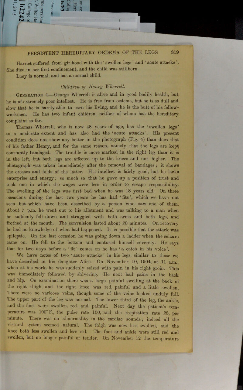 Harriet suffered from girlhood with the c swollen legs ’ and ‘ acute attacks \ She died in her first confinement, and the child was stillborn. Lucy is normal, and has a normal child. Children of Henry Wherrell. Generation 4.—George Wherrell is alive and in good bodily health, but he is of extremely poor intellect. He is free from oedema, but he is so dull and slow that he is barely able to earn his living, and he is the butt of his fellow- workmen. He has two infant children, neither of whom has the hereditary complaint so far. Thomas Wherrell, who is now 48 years of age, has the ‘ swollen legs ’ to a moderate extent and has also had the ‘ acute attacks His present condition does not show any better in the photograph (Fig. 4) than does that of his father Henry, and for the same reason, namely, that the legs are kept constantly bandaged. The trouble is more marked in the right leg than it is in the left, but both legs are affected up to the knees and not higher. The photograph was taken immediately after the removal of bandages ; it shows the creases and folds of the latter. His intellect is fairly good, but he lacks enterprise and energy; so much so that he gave up a position of trust and took one in which the wages were less in order to escape responsibility. The swelling of the legs was first bad when he was 18 years old. On three occasions during the last two years he has had ‘ fits ’, which we have not seen but which have been described by a person who saw one of them. About 7 p.m. he went out to his allotment and was talking to a man when he suddenly fell down and struggled with both arms and both legs, and frothed at the mouth. The convulsion lasted about 20 minutes. On recovery he had no knowledge of what had happened. It is possible that the attack was epileptic. On the last occasion he was going down a ladder when the seizure came on. He fell to the bottom and contused himself severely. He says that for two days before a ‘ fit ’ comes on he has ‘ a catch in his voice ’. We have notes of two £ acute attacks ’ in his legs, similar to those we have described in his daughter Alice. On November 10, 1904, at 11 a.m., when at his work, he was suddenly seized with pain in his right groin. This was immediately followed by shivering. He next had pains in the back and hip. On examination there was a large painful swelling at the back of the right thigh, and the right knee was red, painful and a little swollen. There were no varicose veins, though some of the veins looked unduly full. The upper part of the leg was normal. The lower third of the leg, the ankle, and the foot were swollen, red, and painful. Next day the patient’s tem- perature was 100° F., the pulse rate 100, and the respiration rate 28, per minute. There was no abnormality in the cardiac sounds; indeed all the visceral system seemed natural. The thigh was now less swollen, and the knee both less swollen and less red. The foot and ankle were still red and swollen, but no longer painful or tender. On November 12 the temperature