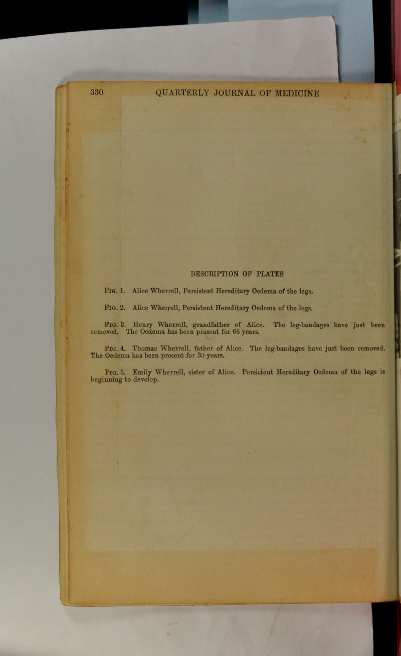 DESCRIPTION OF PLATES Fig. 1. Alice Wherrell, Persistent Hereditary Oedema of the legs. Fig. 2. Alice Wherrell, Persistent Hereditary Oedema of the legs. Fig. 3. Henry Wherrell, grandfather of Alice. The leg-bandages have just been removed. The Oedema has been present for 66 years. Fig. 4. Thomas Wherrell, father of Alice. The leg-bandages have just been removed. The Oedema has been present for 30 years. Fig. 5. Emily Wherrell, sister of Alice. Persistent Hereditary Oedema of the legs is beginning to develop.