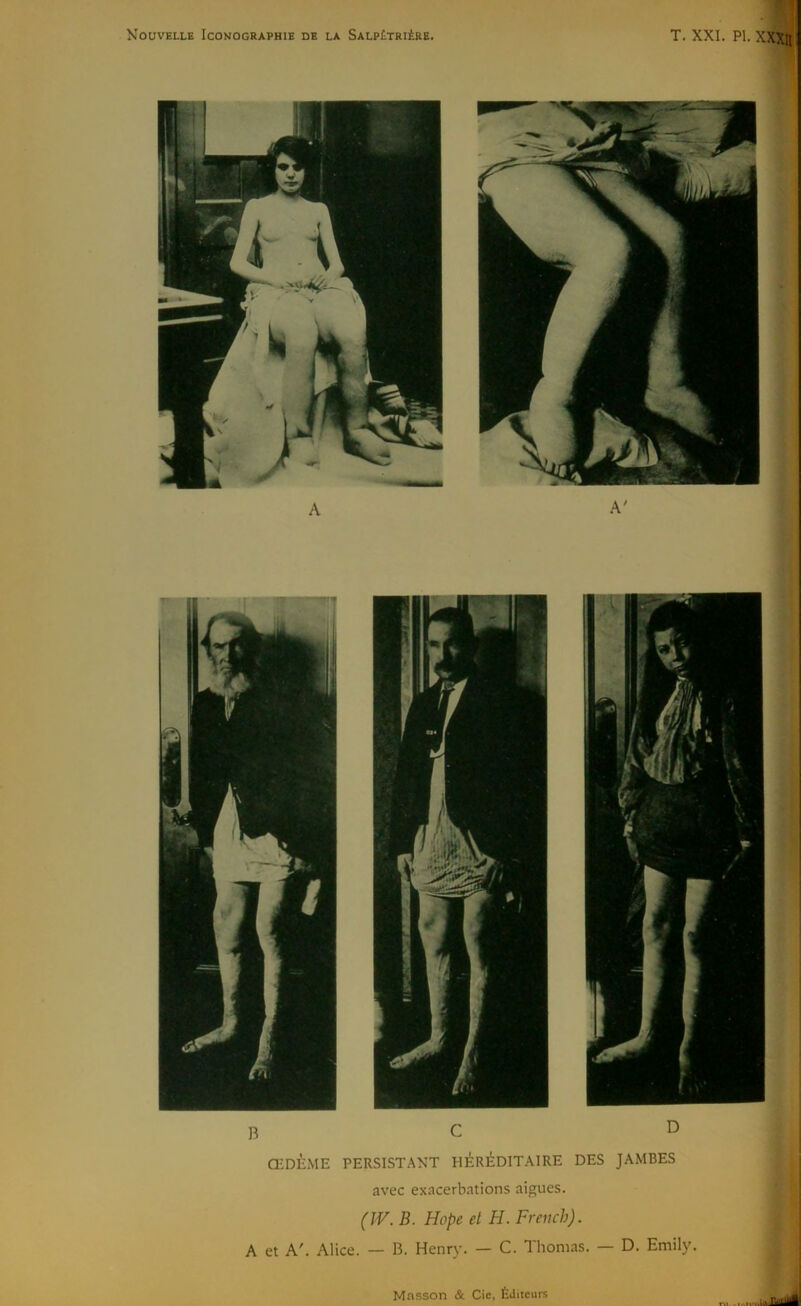 Nouvelle Iconographie de la Salpêtrière. T. XXI. PI. XXXfl A B C D ŒDÈME PERSISTANT HÉRÉDITAIRE DES JAMBES avec exacerbations aigues. (IV. B. Hope et H. Freucb). A et A'. Alice. — B. Henry. — C. Thomas. — D. Ernily. Masson & Cie, Éditeurs r,,