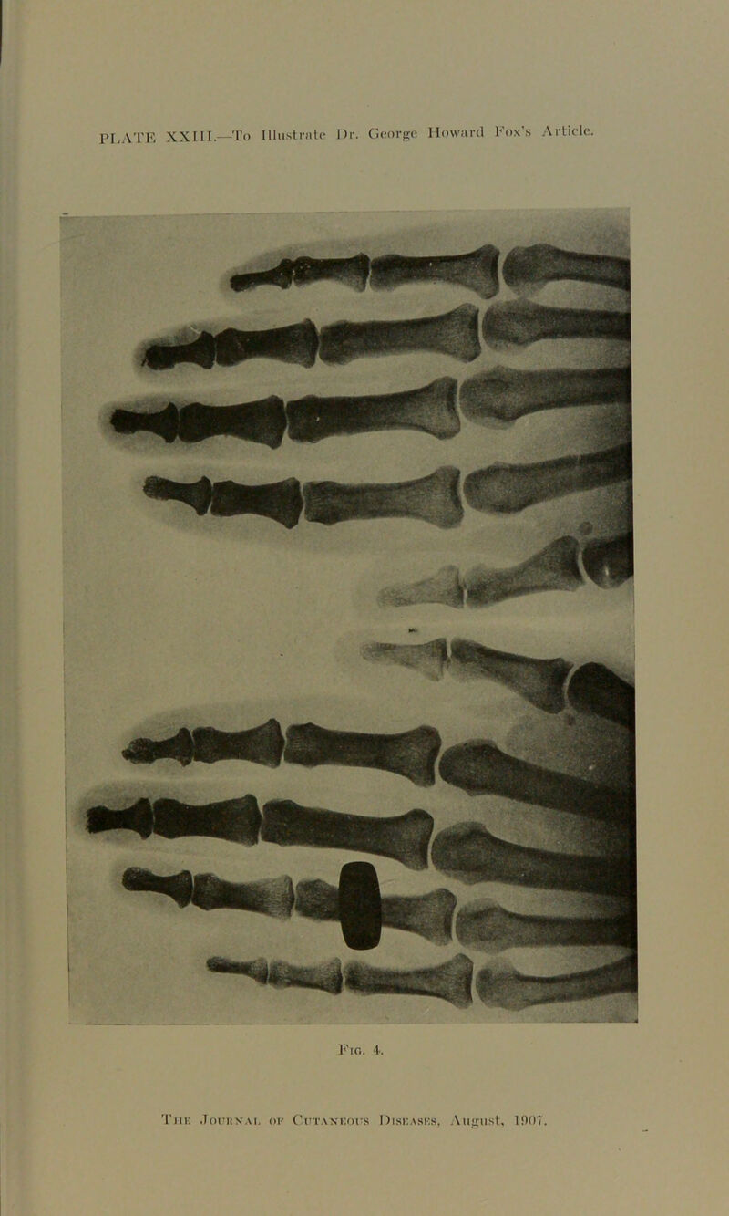 PLATF. XXIII—To Illiistnitc Dr. George Howard Fox’.s .Article. Fio. 4. Tiik Joriix.u. or CtiT.vxKors Diskasks, .\iigiist, 11)07.