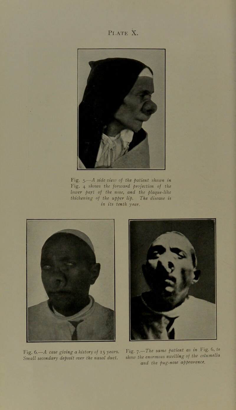 Fig. 5.—A side view of the patient shown in Fig. 4 shoxvs the fonvavd projection of the lower part of the nose, and the plaque-like thickening of the upper lip. The disease is in its tenth year. Fig. 6.—A case giving a history of 15 years. Fig. 7.— The same patient as in 1 ig. 6, to Small secondary deposit over the nasal duct. shoiv the enormous suidling 0) the colume a and the pug-nose appearance.