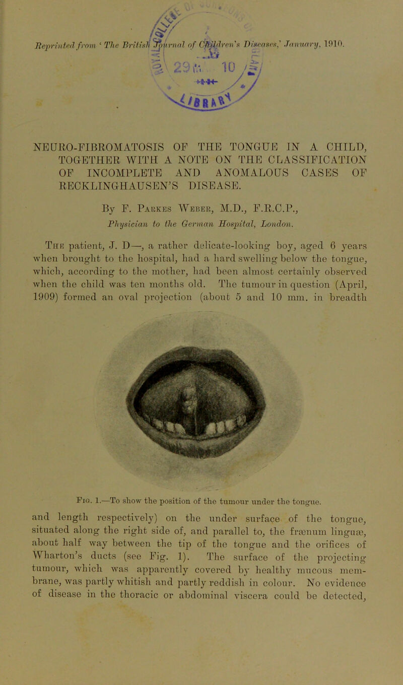 Reprinted from ‘ The BritisA Journal of Children's Diseases,' January, 1010. - ' I . . A'jr A NEURO-FIBROMATOSIS OF THE TONGUE IN A CHILD, TOGETHER WITH A NOTE ON THE CLASSIFICATION OF INCOMPLETE AND ANOMALOUS CASES OF RECKLINGHAUSEN’S DISEASE. By F. Parkes Weber, M.D., F.R.C.P., Physician to the German Hospital, London. The patient, J. D—, a rather delicate-looking boy, aged G years when brought to the hospital, had a hard swelling below the tongue, which, according to the mother, had been almost certainly observed when the child was ten months old. The tumour in question (April, 1909) formed an oval projection (about 5 and 10 mm. in breadth . Fig. 1.—To show the position of the tumour under the tongue. and length respectively) on the under surface of the tongue, situated along the right side of, and parallel to, the frtenum lingute, about half way between the tip of the tongue and the orifices of Wharton’s ducts (see Fig. 1). The surface of the projecting tumour, which was apparently covered by healthy mucous mem- brane, was partly whitish and partly reddish in colour. No evidence of disease in the thoracic or abdominal viscera could be detected.