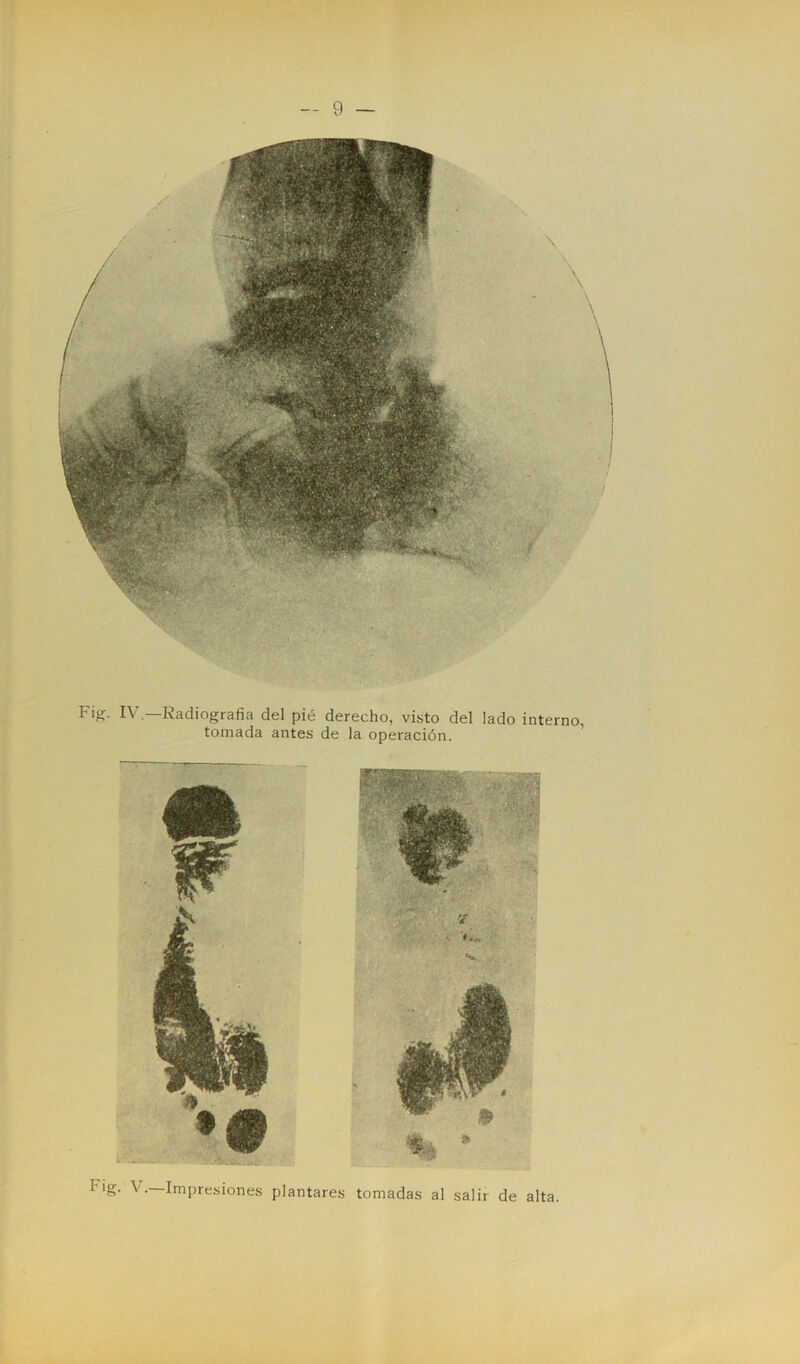 F¡ff- IV—Radiografía del pié derecho, visto del lado interno, tornada antes de la operación. Hg. V.—Impresiones plantares tomadas al salir de alta.