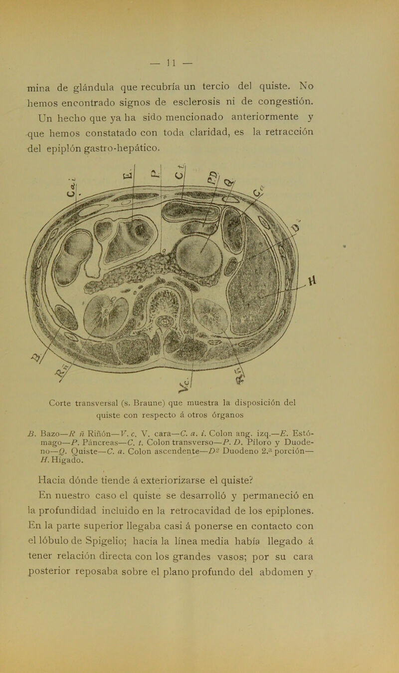 mina de glándula que recubría un tercio del quiste. No hemos encontrado signos de esclerosis ni de congestión. Un hecho que ya ha sido mencionado anteriormente y que hemos constatado con toda claridad, es la retracción del epiplón gastro-hepático. Corte transversal (s. Braune) que muestra la disposición del quiste con respecto á otros órganos B. Bazo—R ñ Riñón—V. c. V. cara—C. a. i. Colon ang. izq.—E. Estó- mago—P. Páncreas—C. t. Colon transverso—P. D. Píloro y Duode- no—Q. Quiste—C. a. Colon ascendente—D~ Duodeno 2.a porción— H. Hígado. Hacia dónde tiende á exteriorizarse el quiste? En nuestro caso el quiste se desarrolló y permaneció en la profundidad incluido en la retrocavidad de los epiplones. En la parte superior llegaba casi á ponerse en contacto con el lóbulo de Spigelio; hacia la línea media había llegado á tener relación directa con los grandes vasos; por su cara posterior reposaba sobre el plano profundo del abdomen y