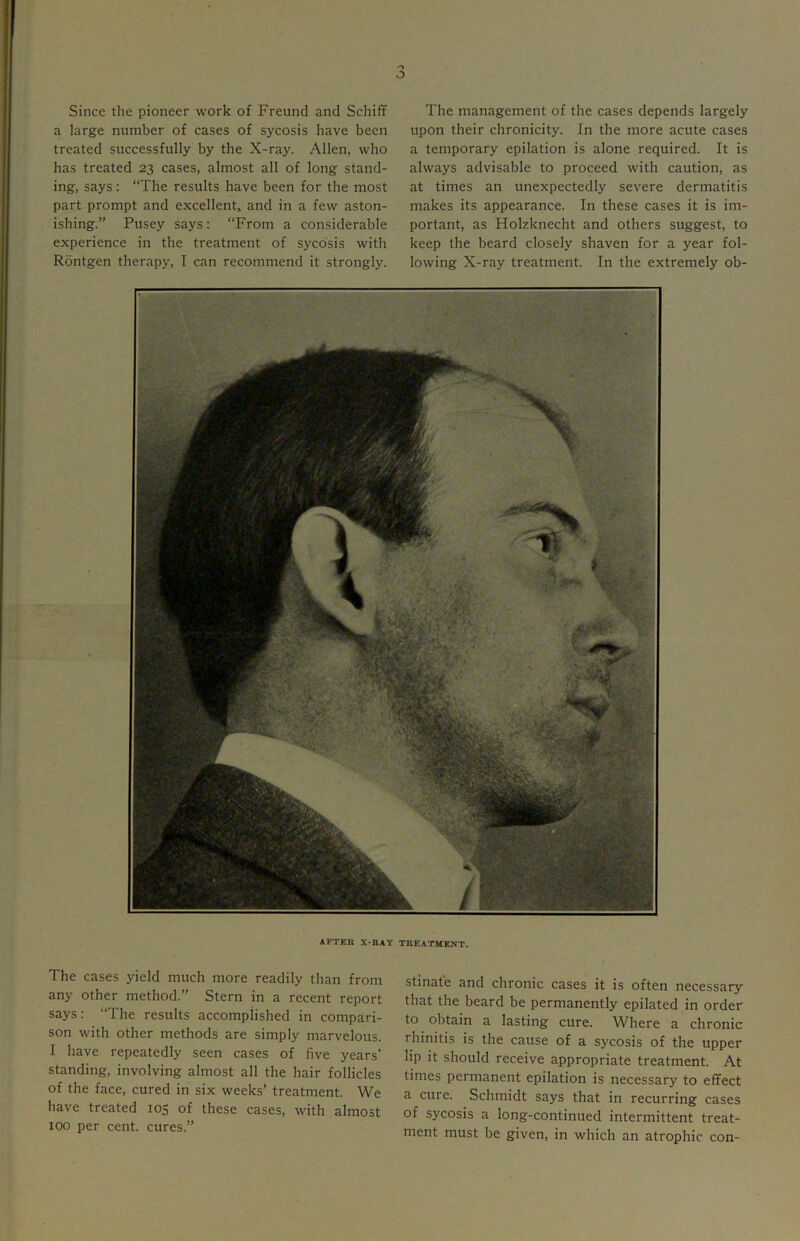 o Since the pioneer work of Freund and Schiff a large number of cases of sycosis have been treated successfully by the X-ray. Allen, who has treated 23 cases, almost all of long stand- ing, says: “The results have been for the most part prompt and excellent, and in a few aston- ishing.” Pusey says: “From a considerable experience in the treatment of sycosis with Rontgen therapy, I can recommend it strongly. The management of the cases depends largely upon their chronicity. In the more acute cases a temporary epilation is alone required. It is always advisable to proceed with caution, as at times an unexpectedly severe dermatitis makes its appearance. In these cases it is im- portant, as Plolzknecht and others suggest, to keep the beard closely shaven for a year fol- lowing X-ray treatment. In the extremely ob- AFTER X-RAY TREATMENT. The cases yield much more readily than from any other method.” Stern in a recent report says: “The results accomplished in compari- son with other methods are simply marvelous. I have repeatedly seen cases of five years’ standing, involving almost all the hair follicles of the face, cured in six weeks’ treatment. We have treated 105 of these cases, with almost 100 per cent, cures.” stinate and chronic cases it is often necessary that the beard be permanently epilated in order to obtain a lasting cure. Where a chronic rhinitis is the cause of a sycosis of the upper lip it should receive appropriate treatment. At times permanent epilation is necessary to effect a cure. Schmidt says that in recurring cases of sycosis a long-continued intermittent treat- ment must be given, in which an atrophic con-