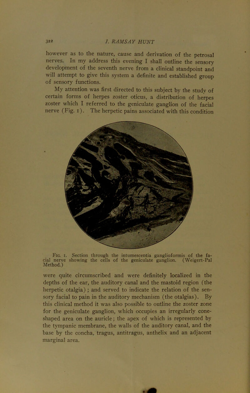 however as to the nature, cause and derivation of the petrosal nerves. In my address this evening I shall outline the sensory development of the seventh nerve from a clinical standpoint and will attempt to give this system a definite and established group of sensory functions. My attention was first directed to this subject by the study of certain forms of herpes zoster oticus, a distribution of herpes zoster which I referred to the geniculate ganglion of the facial nerve (Fig. i). The herpetic pains associated with this condition Fig. i. Section through the intumescentia ganglioformis of the fa- cial nerve showing the cells of the geniculate ganglion. (Weigert-Pal Method.) were quite circumscribed and were definitely localized in the depths of the ear, the auditory canal and the mastoid region (the herpetic otalgia) ; and served to indicate the relation of the sen- sory facial to pain in the auditory mechanism (the otalgias). By this clinical method it was also possible to outline the zoster zone for the geniculate ganglion, which occupies an irregularly cone- shaped area on the auricle; the apex of which is represented by the tympanic membrane, the walls of the auditory canal, and the base by the concha, tragus, antitragus, anthelix and an adjacent marginal area.