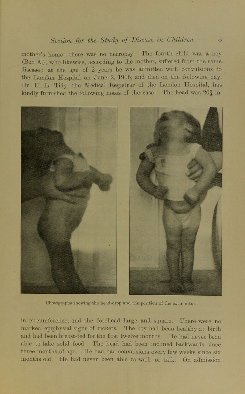 mother’s home; there was no necropsy. The fourth child was a boy (Ben A.), who likewise, according to the mother, suffered from the same disease; at the age of 2 years he was admitted with convulsions to the London Hospital on June 2, 1906, and died on the following day. Dr. H. L. Tidy, the Medical Eegistrar of the London Hospital, has kindly furnished the following notes of the case : The head was 20| in. Photographs showing the head-drop and the position of the extremities. in circumference, and the forehead large and square. There were no marked epiphysial signs of rickets. The boy had been healthy at birth and had been breast-fed for the first twelve months. He had never been able to take solid food. The head had been inclined backwards since three months of age. He had had convulsions every few weeks since six months old. He had never been able to walk or talk. On admission