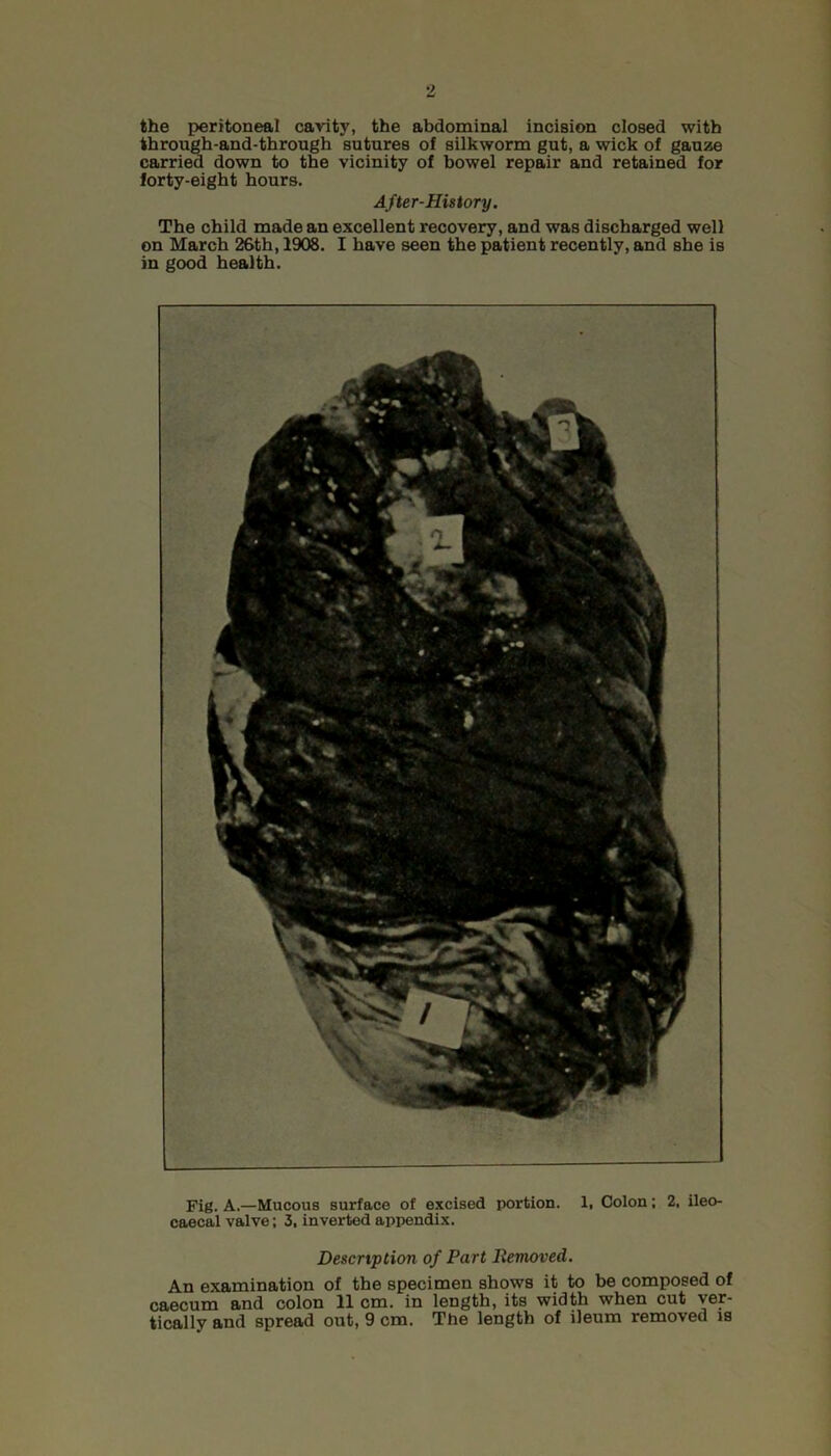 the peritoneal cavity, the abdominal inciBion closed with through-and-through sutures of silkworm gut, a wick of gauze carried down to the vicinity of bowel repair and retained for forty-eight hours. After-History. The child made an excellent recovery, and was discharged well on March 26th, 1908. I have seen the patient recently, and she is in good health. Fig. A.—Mucous surface of excised portion. 1, Colon; 2, ileo- caecal valve; 3, inverted appendix. Description of Part Removed. An examination of the specimen shows it to be composed of caecum and colon 11 cm. in length, its width when cut ver- tically and spread out, 9 cm. The length of ileum removed is