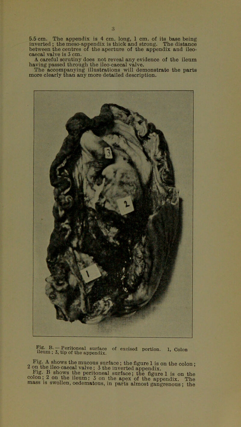 5.5 cm. The appendix is 4 cm. long, 1 cm. of its base being inverted ; the meso-appendix is thick and strong. The distance between the centres of the aperture of the appendix and ileo- caecal valve is 3 cm. A careful scrutiny does not reveal any evidence of the ileum having passed through the ileo-caecal valve. The accompanying illustrations will demonstrate the parts more clearly than any more detailed description. Pig. B.— Peritoneal surface of excised portion. 1, Colon ileum ; 3, tip of the appendix. Fig. A shows the mucous surface; the figure 1 is on the colon ; l on the ileo-caecal valve; 3 the inverted appendix. Fig. B shows the peritoneal surface; the figure 1 is on the colon; 2 on the ileum; 3 on the apex of the appendix. The mass is swollen, oedematous, in parts almost gangrenous ; the