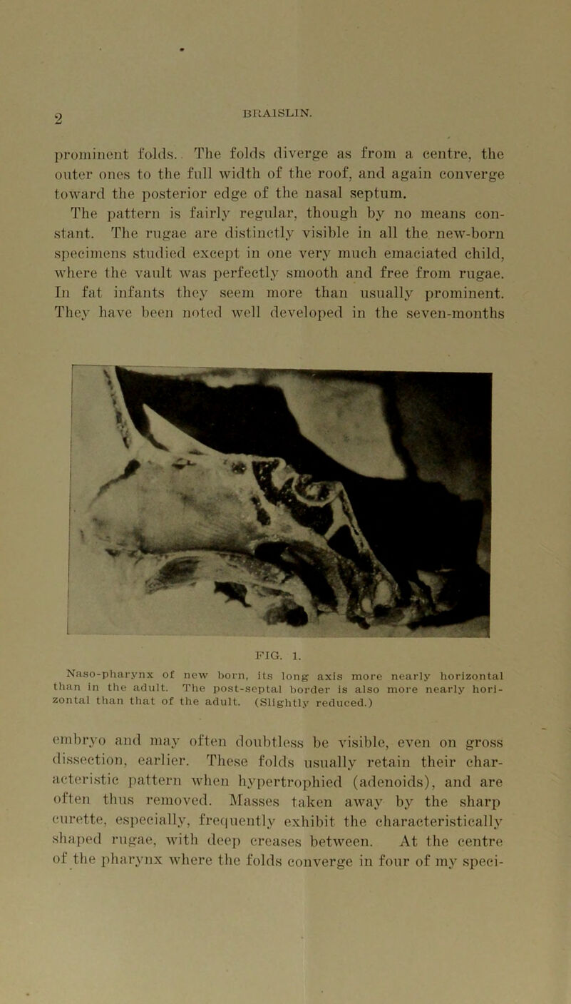 proniinoiit folds.. The folds diverge as from a centre, the outer ones to the full Avidth of the roof, and again converge toward the posterior edge of the nasal septum. The pattern is fairly regular, though by no means con- stant. The rugae are distinctly visible in all the new-born specimens .studied except in one very much emaciated child, where the vault was perfectly smooth and free from rugae. In fat infants they seem more than usually prominent. They have been noted well developed in the seven-months FIG. 1. Naso-pharynx of new born, its long axis more nearly horizontal than in the adult. The post-septal border is also more nearly hori- zontal than that of the adult. (Slightly reduced.) einliryo and may often doubtless be visible, even on gross di.ssection, earlier. These folds usually retain their char- acteri.stic jiattern when hypertrophied (adenoids), and are often thus removed. Masses taken away by the sharp curette, especially, fref|uently exhibit the characteristically shaped rugae, with deep creases betAveen. At the centre of the pharynx Avhere the folds converge in four of my .speci-