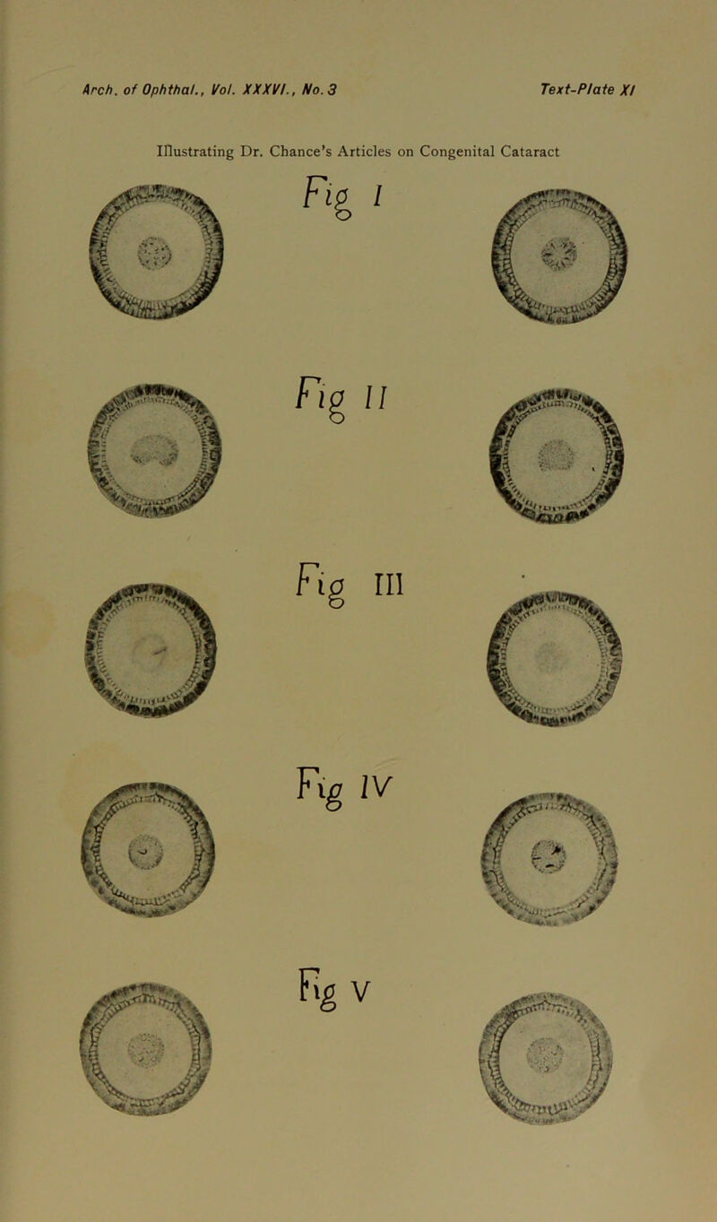 Arch, of Ophthal., Ifol. XXXV!., No. 3 Text-Plate X! Illustrating Dr. Chance’s Articles on Congenital Cataract Fip II Fig in