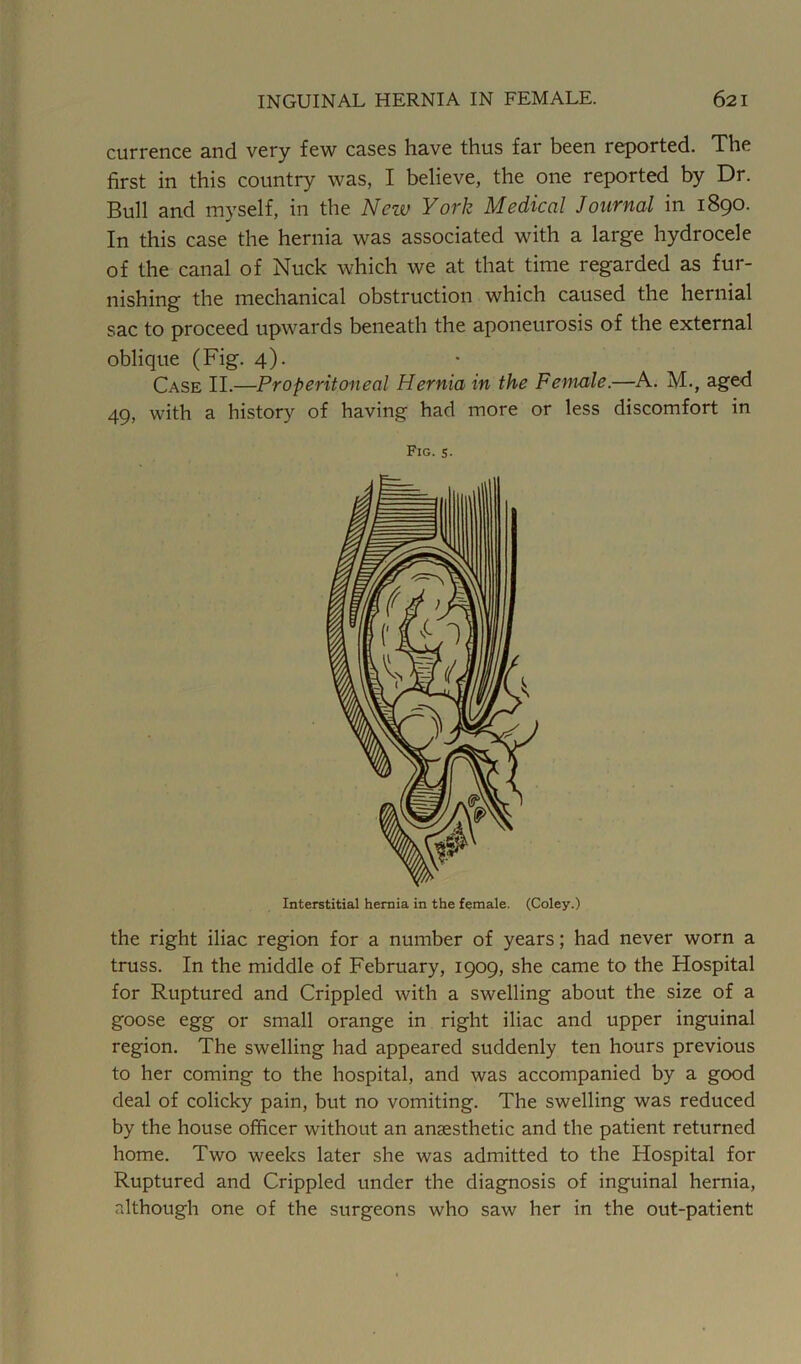 currence and very few cases have thus far been reported. The first in this country was, I believe, the one reported by Dr. Bull and myself, in the New York Medical Journal in 1890. In this case the hernia was associated with a large hydrocele of the canal of Nuck which we at that time regarded as fur- nishing the mechanical obstruction which caused the hernial sac to proceed upwards beneath the aponeurosis of the external oblique (Fig. 4). Case II.—Properitoneal Hernia in the Female.—A. M.} aged 49, with a history of having had more or less discomfort in Fig. S- the right iliac region for a number of years; had never worn a truss. In the middle of February, 1909, she came to the Hospital for Ruptured and Crippled with a swelling about the size of a goose egg or small orange in right iliac and upper inguinal region. The swelling had appeared suddenly ten hours previous to her coming to the hospital, and was accompanied by a good deal of colicky pain, but no vomiting. The swelling was reduced by the house officer without an anaesthetic and the patient returned home. Two weeks later she was admitted to the Hospital for Ruptured and Crippled under the diagnosis of inguinal hernia, although one of the surgeons who saw her in the out-patient