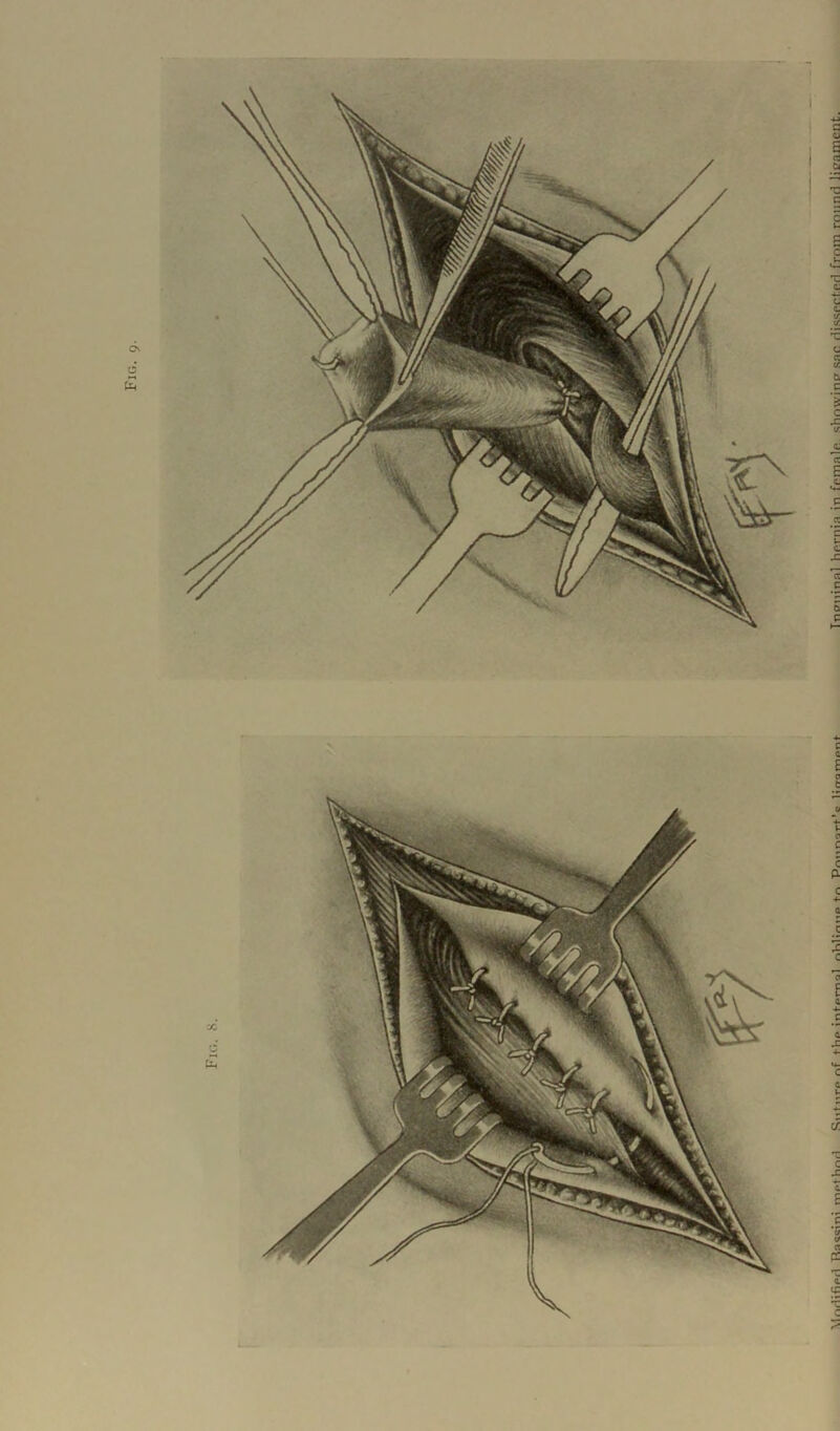 Fig. Raccini rr»ofKr»r1 r,f fVin infomol mo +r\ Pmmorf'c lirromnnf Tnoiiinnl hernia in fpmalp. shmvinff sap HisspriftH from round ligament.