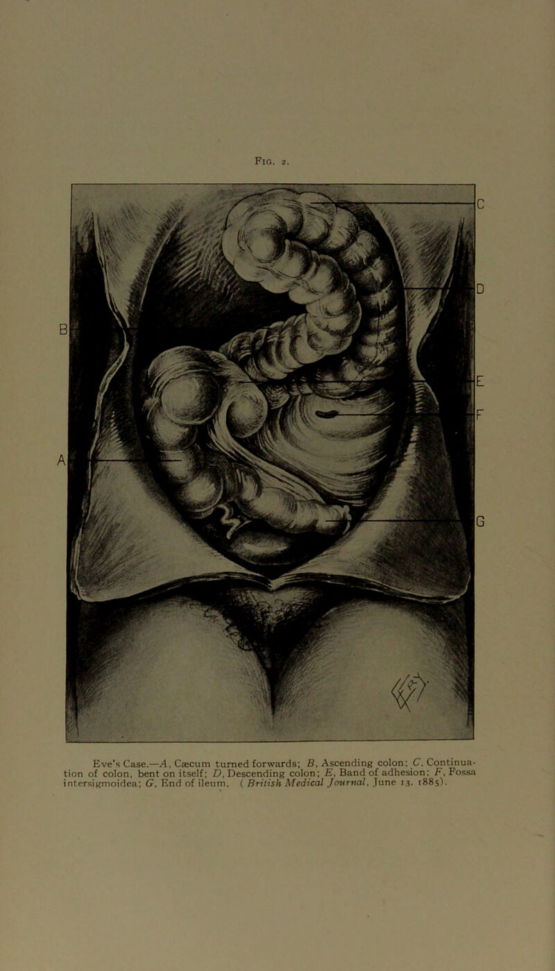 Eve’s Case.—A, Caecum turned forwards; B, Ascending colon; C, Continua- tion of colon, bent on itself; D, Descending colon; E, Band of adhesion; F, Fossa inter.sigmoidea; G, End of ileum. ( British Medical Journal, June i.s. 1885).