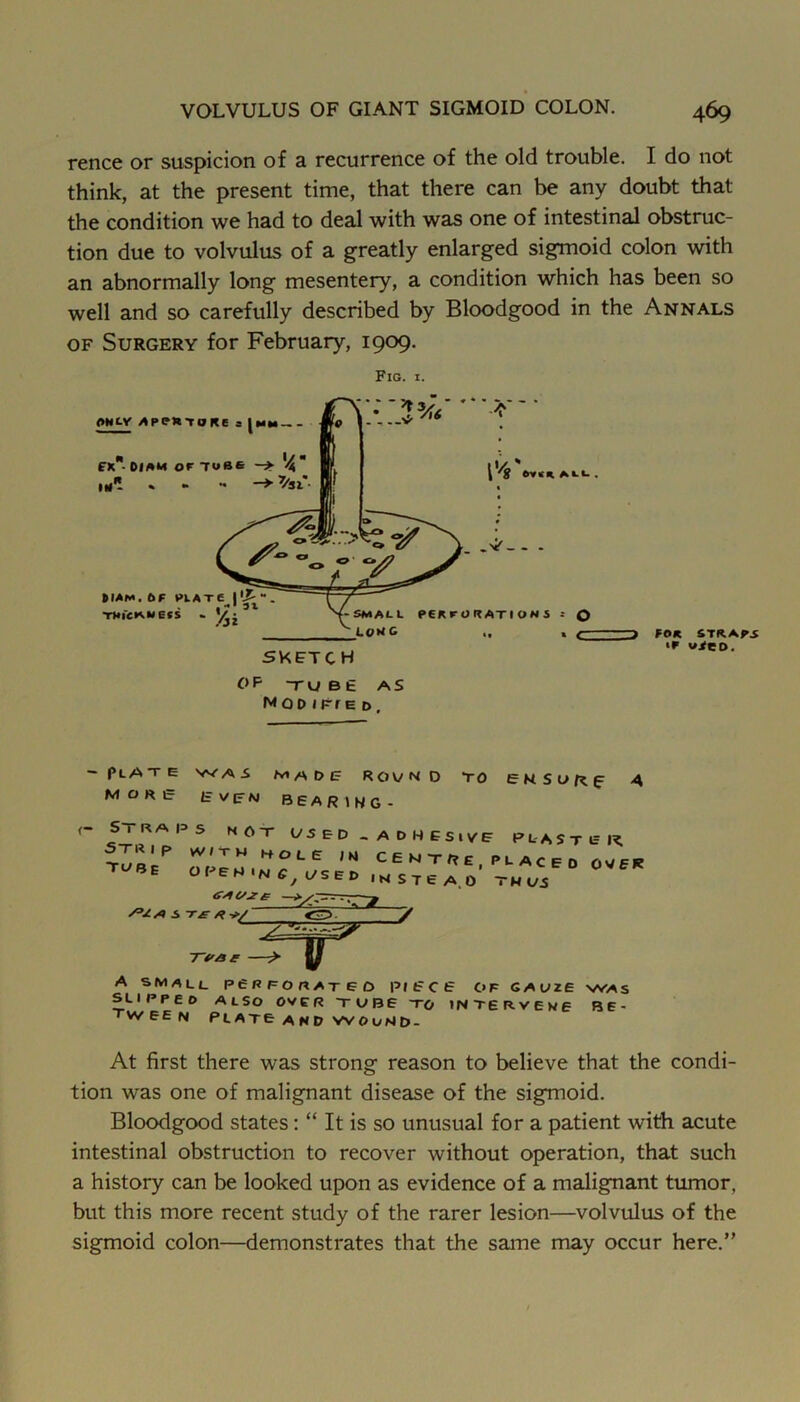 fence or suspicion of a recurrence of the old trouble. I do not think, at the present time, that there can be any doubt that the condition we had to deal with was one of intestinal obstruc- tion due to volvulus of a greatly enlarged sigmoid colon with an abnormally long mesentery, a condition which has been so well and so carefully described by Bloodgood in the Annals OF Surgery for February, 1909. Fig. I. OP TUBE AS MOD iFfE i>. Plate was maDi= RovnD TO EMSuf^f A MORi= EvirM bearing- SiRAI^S NOT C/SED. Strip w//-rw hole ;ki Tl>8e o Re w'n i/s e d ADHESIVE PL'ASTEK C E M T R £ ^ P U A C E 0 OVER • HSTEA.O THUS i -r£ V A SMALL SLI PPE D TVV EE N PeRFORATED PIECE C>F GAUZE WAS Also over tube to interveme be- F*-ATC and VVOuHD- At first there was strong reason to believe that the condi- tion was one of malignant disease of the sigmoid. Bloodgood states; “ It is so unusual for a patient with acute intestinal obstruction to recover without operation, that such a history can be looked upon as evidence of a malignant tumor, but this more recent study of the rarer lesion—volvulus of the sigmoid colon—demonstrates that the same may occur here.”