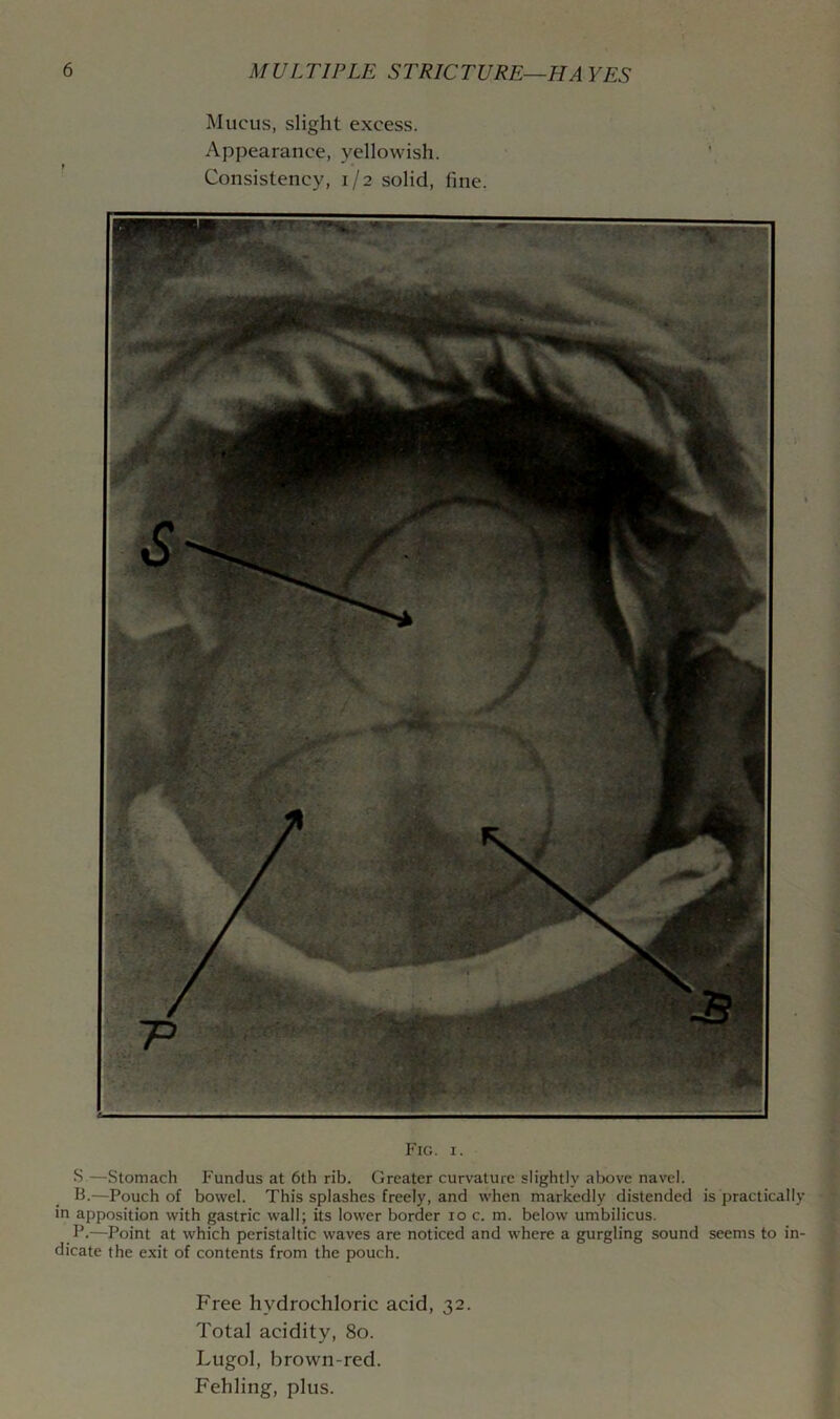 Mucus, slight excess. Appearance, yellowish. Consistency, 1/2 solid, fine. Fig. I. S.—Stomach Fundus at 6th rib. Greater curvature slightly above navel. B.—Pouch of bowel. This splashes freely, and when markedly distended is practically in apposition with gastric wall; its lower border 10 c. m. below umbilicus. F.—Point at which peristaltic waves are noticed and where a gurgling sound seems to in- dicate the exit of contents from the pouch. Free hydrochloric acid, 32. Total acidity, 80. Lugol, brown-red. Fehling, plus.
