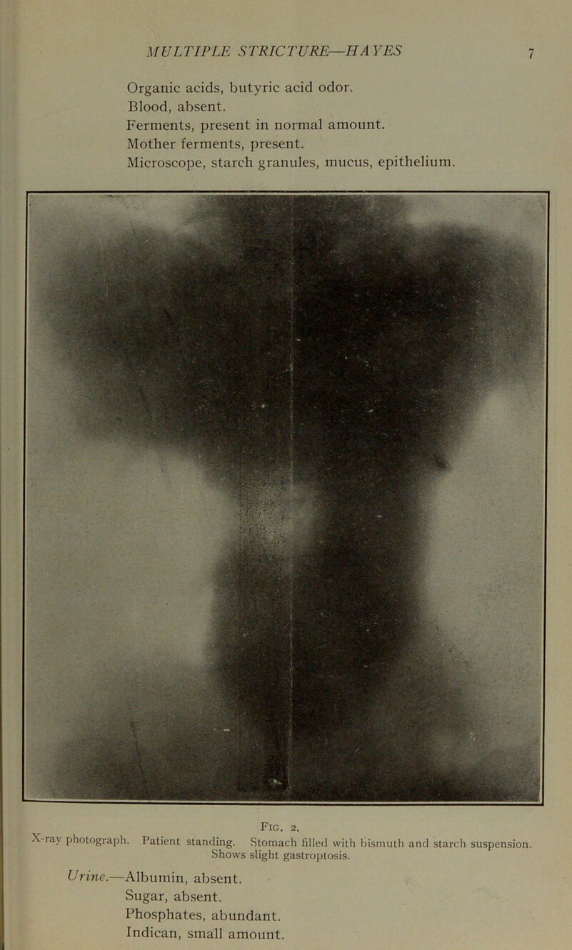 Organic acids, butyric acid odor. Blood, absent. Ferments, present in normal amount. Mother ferments, present. Microscope, starch granules, mucus, epithelium. Fig. 2. X-ray photograph. Patient standing. Stomach filled with bismuth and starch suspension. Shows slight gastroptosis. Urine.—Albumin, absent. Sugar, absent. Phosphates, abundant. Indican, small amount.