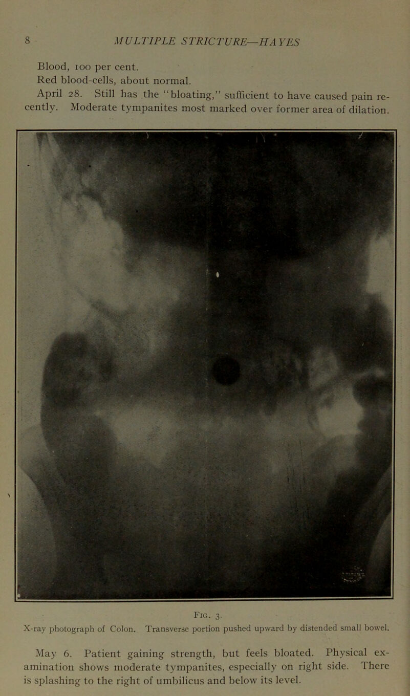Blood, loo per cent. Red blood-cells, about normal. April 28. Still has the “bloating,” sufficient to have caused pain re- cently. Moderate tympanites most marked over former area of dilation. Fig. 3. X-ray photograph of Colon. Transverse portion pushed upward by distended small bowel. May 6. Patient gaining strength, but feels bloated. Physical ex- amination shows moderate tympanites, especially on right side. There is splashing to the right of umbilicus and below its level.