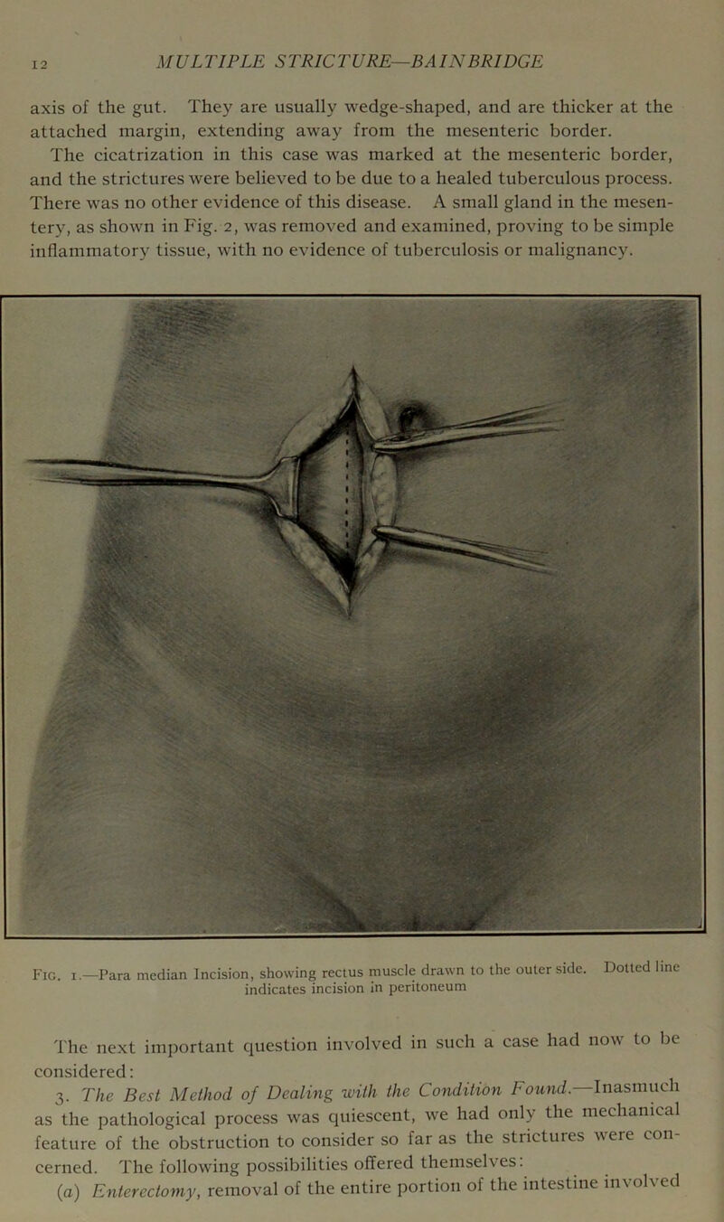 axis of the gut. They are usually wedge-shaped, and are thicker at the attached margin, extending away from the mesenteric border. The cicatrization in this case was marked at the mesenteric border, and the strictures were believed to be due to a healed tuberculous process. There was no other evidence of this disease. A small gland in the mesen- tery, as shown in Fig. 2, was removed and examined, proving to be simple inflammatory tissue, with no evidence of tuberculosis or malignancy. Fig. I.—Para median Incision, showing rectus muscle drawn to the outer side. Dotted line indicates incision in peritoneum The next important question involved in such a case had now to be considered: 3. The Best Method of Dealing with the Condition Fownti.—Inasmuch as the pathological process was quiescent, we had only the mechanical feature of the obstruction to consider so far as the strictures were con cerned. fl'he following possibilities offered themselves. (a) Enterectomy, removal of the entire portion of the intestine involved