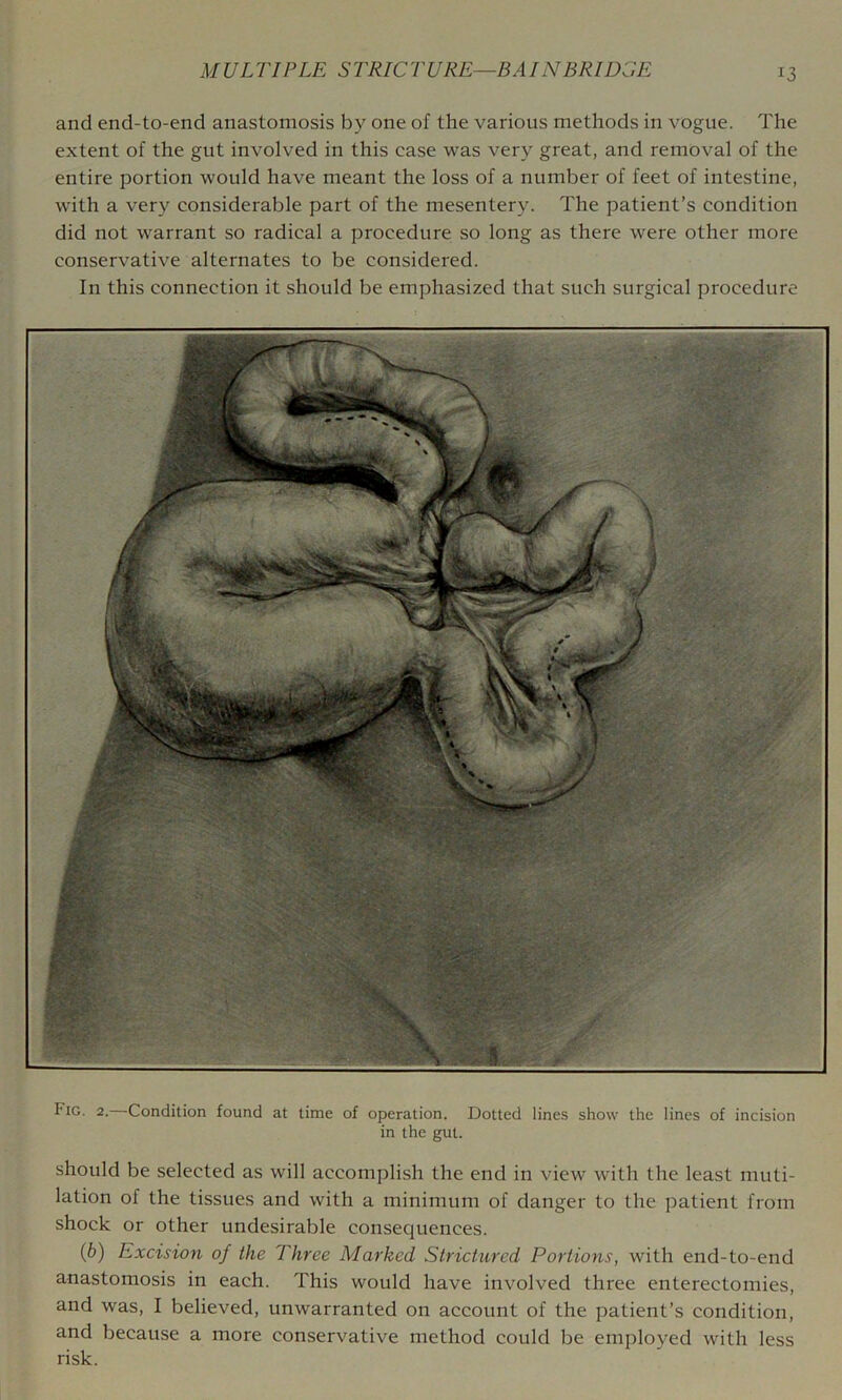 and end-to-end anastomosis by one of the various methods in vogue. The extent of the gut involved in this case was very great, and removal of the entire portion would have meant the loss of a number of feet of intestine, w'ith a very considerable part of the mesentery. The patient’s condition did not warrant so radical a procedure so long as there were other more conservative alternates to be considered. In this connection it should be emphasized that such surgical procedure Fig. 2.—Condition found at time of operation. Dotted lines show the lines of incision in the gut. should be selected as will accomplish the end in view with the least muti- lation of the tissues and with a minimum of danger to the patient from shock or other undesirable consequences. (6) Excision of the Three Marked Strictured Portions, with end-to-end anastomosis in each. This would have involved three enterectomies, and was, I believed, unwarranted on account of the patient’s condition, and because a more conservative method could be employed with less risk.