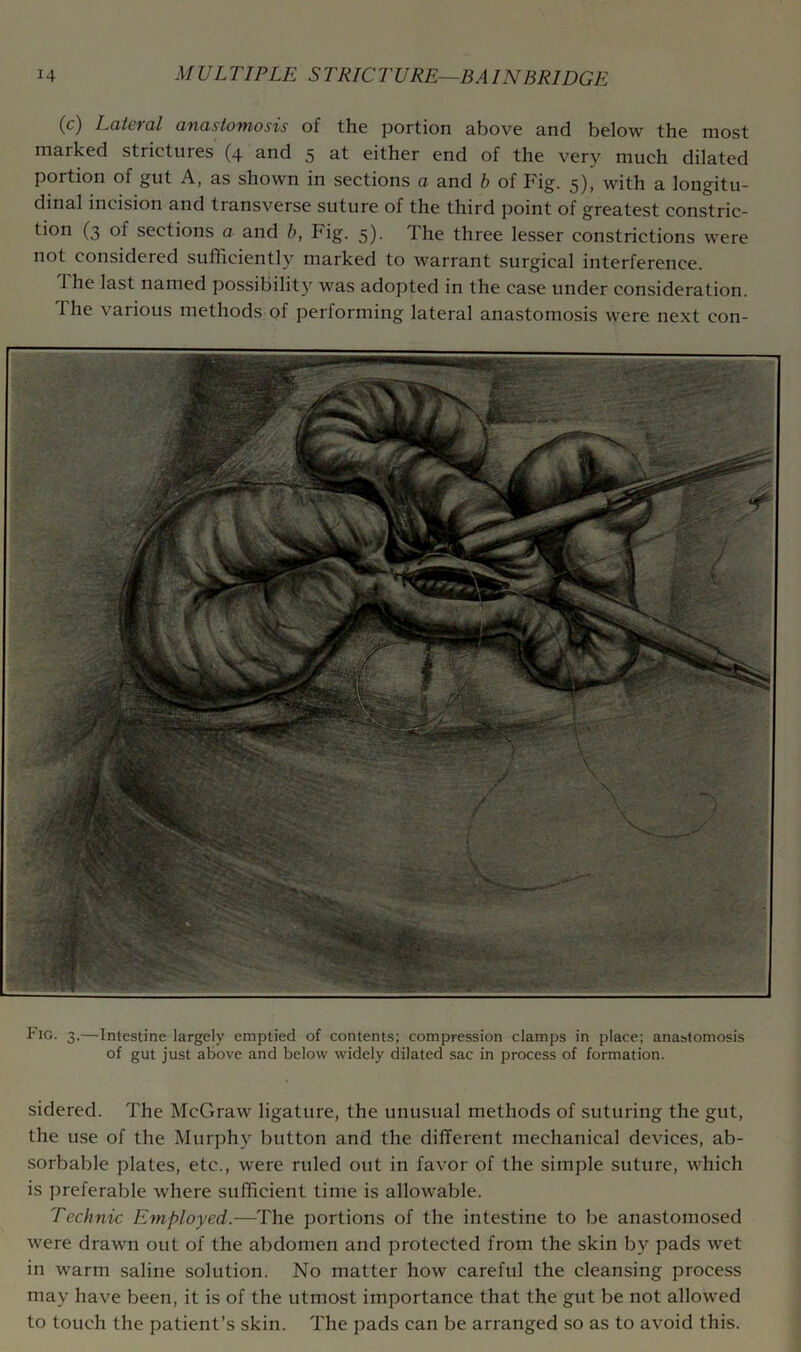 (c) LdtcTdl dfidstomosis of the portion above and below the most marked strictures (4 and 5 at either end of the very much dilated portion of gut A, as shown in sections a and b of Fig. 5), with a longitu- dinal incision and transverse suture of the third point of greatest constric- tion (3 of sections a and h, Fig. 5). The three lesser constrictions were not considered sufficiently marked to warrant surgical interference. The last named possibility was adopted in the case under consideration. The various methods of performing lateral anastomosis were next con- Fig- 3.—Intestine largely emptied of contents; compression clamps in place; anastomosis of gut just above and below widely dilated sac in process of formation. sidered. The McGraw ligature, the unusual methods of suturing the gut, the use of the Murphy button and the different mechanical devices, ab- sorbable plates, etc., were ruled out in favor of the simple suture, which is preferable where sufficient time is allowable. Technic Employed.—The portions of the intestine to be anastomosed were drawn out of the abdomen and protected from the skin by pads wet in warm saline solution. No matter how careful the cleansing process may have been, it is of the utmost importance that the gut be not allowed to touch the patient’s skin. The pads can be arranged so as to avoid this.