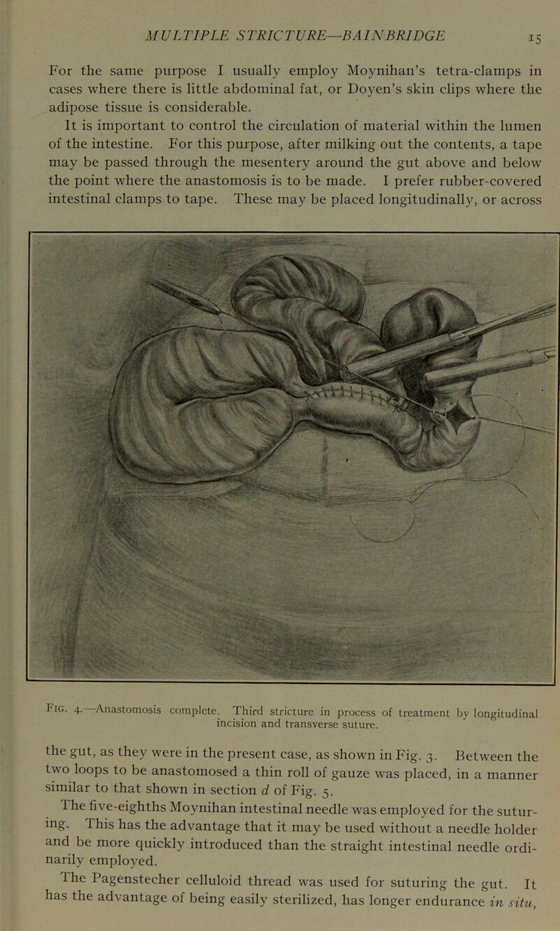 For the same purpose I usually employ Moynihan’s tetra-clamps in cases where there is little abdominal fat, or Doyen’s skin clips where the adipose tissue is considerable. It is important to control the circulation of material within the lumen of the intestine. F'or this purpose, after milking out the contents, a tape may be passed through the mesentery around the gut above and below the point where the anastomosis is to be made. I prefer rubber-covered intestinal clamps to tape. These may be placed longitudinally, or across Fig. 4. Anastomosis complete. Third stricture in process of treatment by longitudinal incision and transverse suture. the gut, as they were in the present case, as shown in Fig. 3. Between the two loops to be anastomosed a thin roll of gauze was placed, in a manner similar to that shown in section d of Fig. 5. 1 he five-eighths Moynihan intestinal needle was employed for the sutur- ing. This has the advantage that it may be used without a needle holder and be more quickly introduced than the straight intestinal needle ordi- narily employed. Ihe Pagenstecher celluloid thread was used for suturing the gut. It has the advantage of being easily sterilized, has longer endurance in situ,