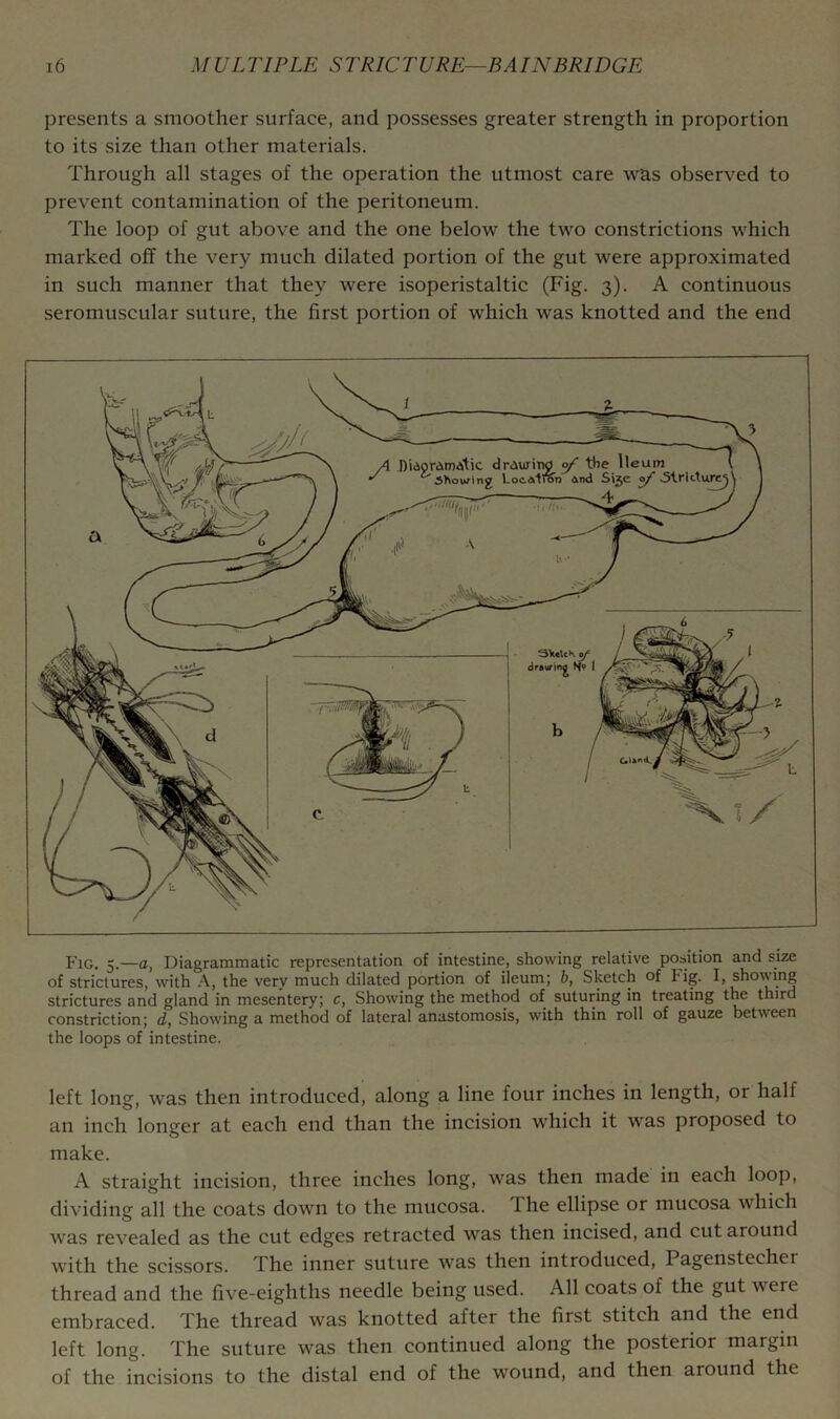presents a smoother surface, and possesses greater strength in proportion to its size than other materials. Through all stages of the operation the utmost care was observed to prevent contamination of the peritoneum. The loop of gut above and the one below the two constrictions which marked off the very much dilated portion of the gut were approximated in such manner that they were isoperistaltic (Fig. 3). A continuous seromuscular suture, the first portion of which was knotted and the end A Didprdmaitic ( showing draurit^ ^ tl f LocalraV) And le Ileum \ Si5e ©/■ 5irktu^ Fig. 5.—a, Diagrammatic representation of intestine, showing relative position and size of strictures, with the very much dilated portion of ileum; b, Sketch of Fig. I, showing strictures and gland in mesentery; c, Showing the method of suturing in treating the third constriction; d, Showing a method of lateral anastomosis, with thin roll of gauze between the loops of intestine. left long, was then introduced, along a line four inches in length, or half an inch longer at each end than the incision which it was proposed to make. A straight incision, three inches long, was then made in each loop, dividing all the coats down to the mucosa. The ellipse or mucosa which was revealed as the cut edges retracted was then incised, and cut around with the scissors. The inner suture was then introduced, Pagenstecher thread and the five-eighths needle being used. All coats of the gut were embraced. The thread was knotted after the first stitch and the end left long. The suture was then continued along the posterior margin of the incisions to the distal end of the wound, and then around the