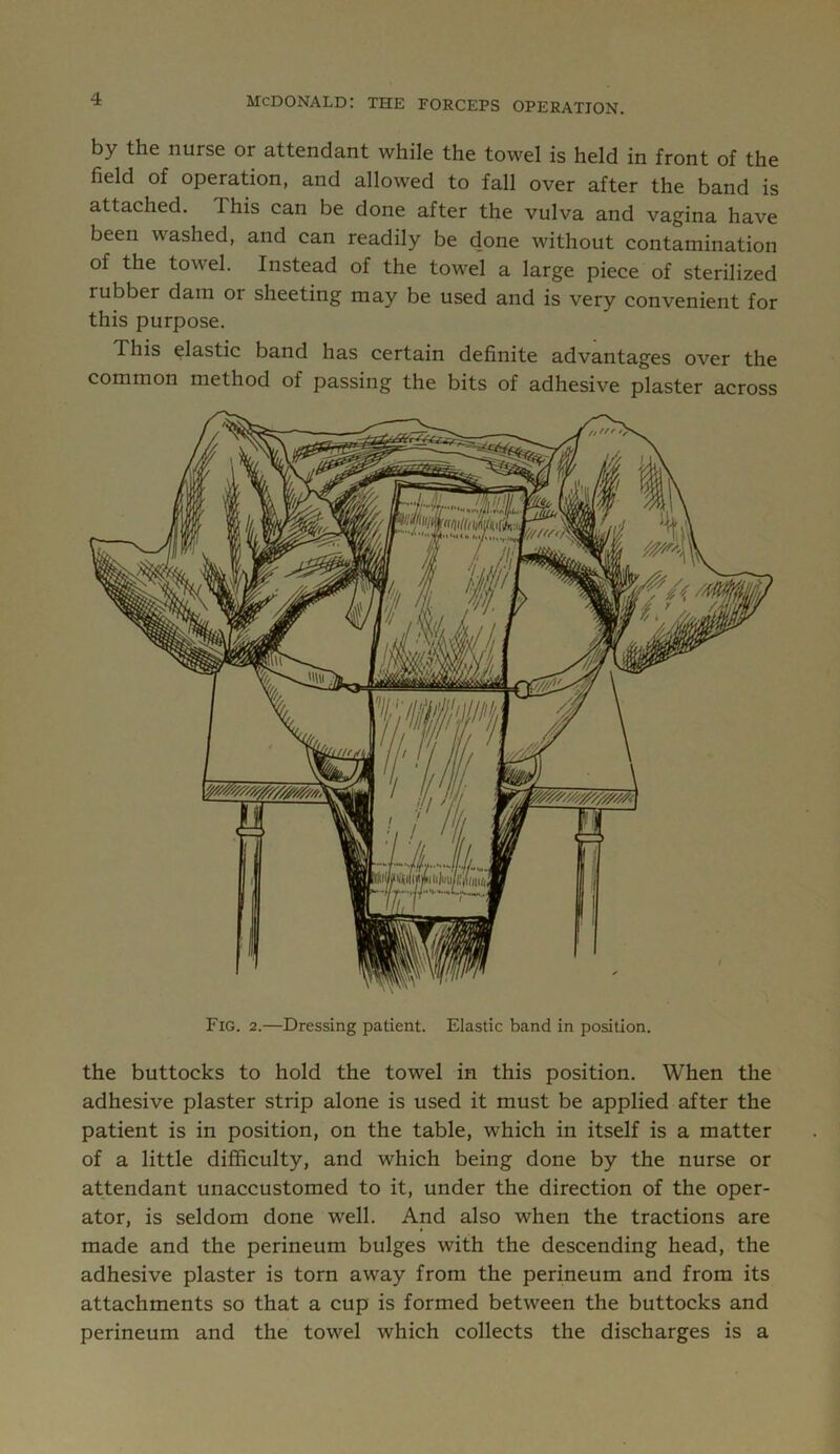 by the nurse or attendant while the towel is held in front of the field of operation, and allowed to fall over after the band is attached. This can be done after the vulva and vagina have been washed, and can readily be done without contamination of the towel. Instead of the towel a large piece of sterilized rubber dam or sheeting may be used and is very convenient for this purpose. This elastic band has certain definite advantages over the common method of passing the bits of adhesive plaster across the buttocks to hold the towel in this position. When the adhesive plaster strip alone is used it must be applied after the patient is in position, on the table, which in itself is a matter of a little difficulty, and which being done by the nurse or attendant unaccustomed to it, under the direction of the oper- ator, is seldom done w'ell. And also when the tractions are made and the perineum bulges with the descending head, the adhesive plaster is torn away from the perineum and from its attachments so that a cup is formed between the buttocks and perineum and the towel which collects the discharges is a