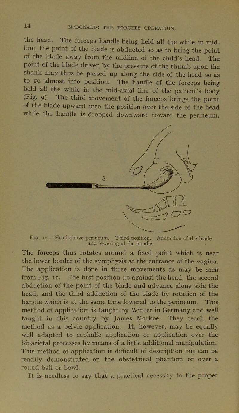 the head. The forceps handle being held all the while in mid- line, the point of the blade is abducted so as to bring the point of the blade away from the midline of the child’s head. The point of the blade driven by the pressure of the thumb upon the shank may thus be passed up along the side of the head so as to go almost into position. The handle of the forceps being held all the while in the mid-axial line of the patient’s body (Fig. 9). The third movement of the forceps brings the point of the blade upward into the position over the side of the head while the handle is dropped downward toward the perineum. Fig. 10.—Head above perineum. Third position. Adduction of the blade and lowering of the handle. The forceps thus rotates around a fixed point which is near the lower border of the symphysis at the entrance of the vagina. The application is done in three movements as may be seen from Fig. ii. The first position up against the head, the second abduction of the point of the blade and advance along side the head, and the third adduction of the blade by rotation of the handle which is at the same time lowered to the perineum. This method of application is taught by Winter in Germany and well taught in this country by James Markoe. They teach the method as a pelvic application. It, however, may be equally well adapted to cephalic application or application over the biparietal processes by means of a little additional manipulation. This method of application is difficult of description but can be readily demonstrated on the obstetrical phantom or over a round ball or bowl. It is needless to say that a practical necessity to the proper