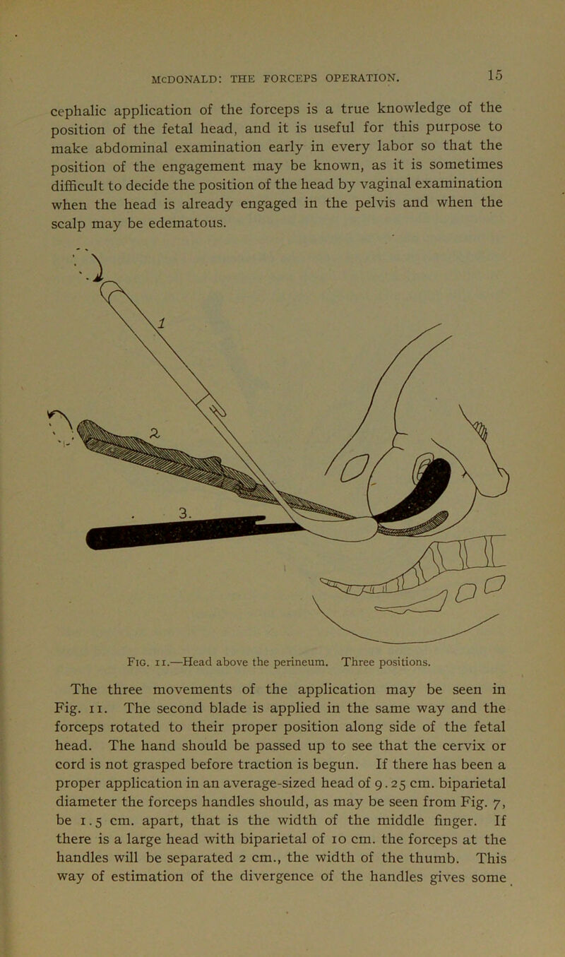 cephalic application of the forceps is a true knowledge of the position of the fetal head, and it is useful for this purpose to make abdominal examination early in every labor so that the position of the engagement may be known, as it is sometimes difficult to decide the position of the head by vaginal examination when the head is already engaged in the pelvis and when the scalp may be edematous. Fig. II.—Head above the perineum. Three positions. The three movements of the application may be seen in Fig. II. The second blade is applied in the same way and the forceps rotated to their proper position along side of the fetal head. The hand should be passed up to see that the cervix or cord is not grasped before traction is begun. If there has been a proper application in an average-sized head of 9.25 cm. biparietal diameter the forceps handles should, as may be seen from Fig. 7, be 1.5 cm. apart, that is the width of the middle finger. If there is a large head with biparietal of 10 cm. the forceps at the handles will be separated 2 cm., the width of the thumb. This way of estimation of the divergence of the handles gives some