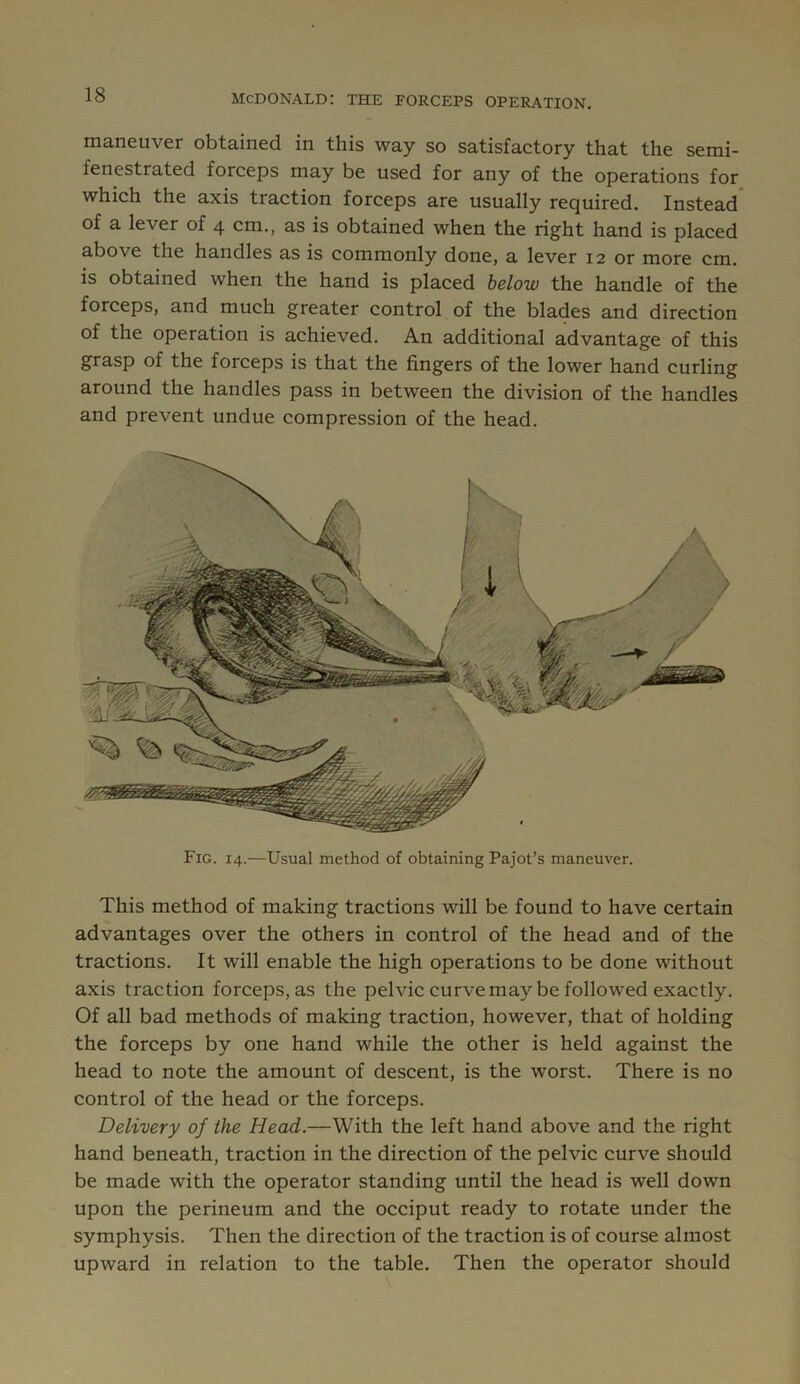 maneuver obtained in this way so satisfactory that the semi- fenestrated forceps may be used for any of the operations for which the axis traction forceps are usually required. Instead* of a lever of 4 cm., as is obtained when the right hand is placed above the handles as is commonly done, a lever 12 or more cm. is obtained when the hand is placed below the handle of the forceps, and much greater control of the blades and direction of the operation is achieved. An additional advantage of this grasp of the forceps is that the fingers of the lower hand curling around the handles pass in between the division of the handles and prevent undue compression of the head. Fig. 14.—Usual method of obtaining Pajot’s maneuver. This method of making tractions will be found to have certain advantages over the others in control of the head and of the tractions. It will enable the high operations to be done without axis traction forceps, as the pelvic curve may be followed exactly. Of all bad methods of making traction, however, that of holding the forceps by one hand while the other is held against the head to note the amount of descent, is the worst. There is no control of the head or the forceps. Delivery of the Head.—With the left hand above and the right hand beneath, traction in the direction of the pelvic curve should be made with the operator standing until the head is well down upon the perineum and the occiput ready to rotate under the symphysis. Then the direction of the traction is of course almost upward in relation to the table. Then the operator should