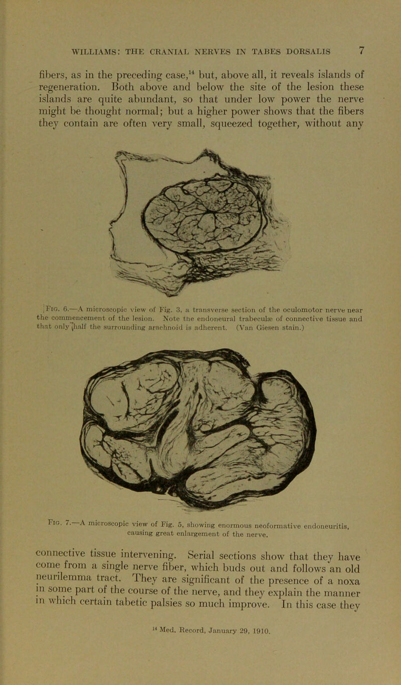 fibers, as in the preceding case,^'* but, above all, it reveals islands of regeneration. Both above and below the site of the lesion these islands are quite abundant, so that under low power the nerve might be thought normal; but a higher power shows that the fibers they contain are often very small, squeezed together, without any ,Fig. 6.—A microscopic view of Fig. 3, ii transverse section of the oculomotor nerve near the commencement of the lesion. Note the endoneural trabeculre of connective tissue and that only jhalf the surrounding arachnoid is adherent. (Van Giesen stain.) Fio. 7. A microscopic view of Fig. 5, showing enormous neoformative endoneuritis, causing great enlargement of the nerve. connective tissue intervening. Serial sections show that they have come from a single nerve fiber, which buds out and follows an old neurilemma tract. They are significant of the presence of a noxa in some part of the course of the nerve, and they explain the manner in which certain tabetic palsies so much improve. In this case they Med. Record, January 29, 1910.