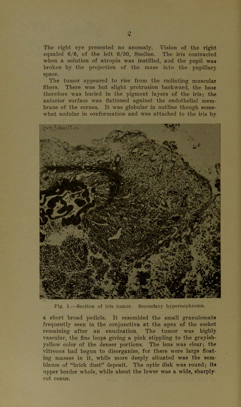 equaled 6/6, of the left 6/30, Snellen. The iris contracted when a solution of atropin was instilled, and the pupil was broken by the projection of the mass into the pupillary space. The tumor appeared to rise from the radiating muscular fibers. There was but slight protrusion backward, the base therefore was buried in the pigment layers of the iris; the anterior surface was flattened against the endothelial mem- brane of the cornea. It was globular in outline though some- what nodular in conformation and was attached to the iris by Fig. 1.—Section of iris tumor. Secondary hypernephroma. a short broad pedicle. It resembled the small granulomata frequently seen in the conjunctiva at the apex of the socket remaining after an enucleation. The tumor was highly vascular, the fine loops giving a pink stippling to the grayish- yellow color of the denser portions. The lens was clear; the vitreous had begun to disorganize, for there were large float- ing masses in it, while more deeply situated was the sem- blance of “brick dust” deposit. The optic disk was round; its upper border whole, while about the lower was a wide, sharply- cut conus.